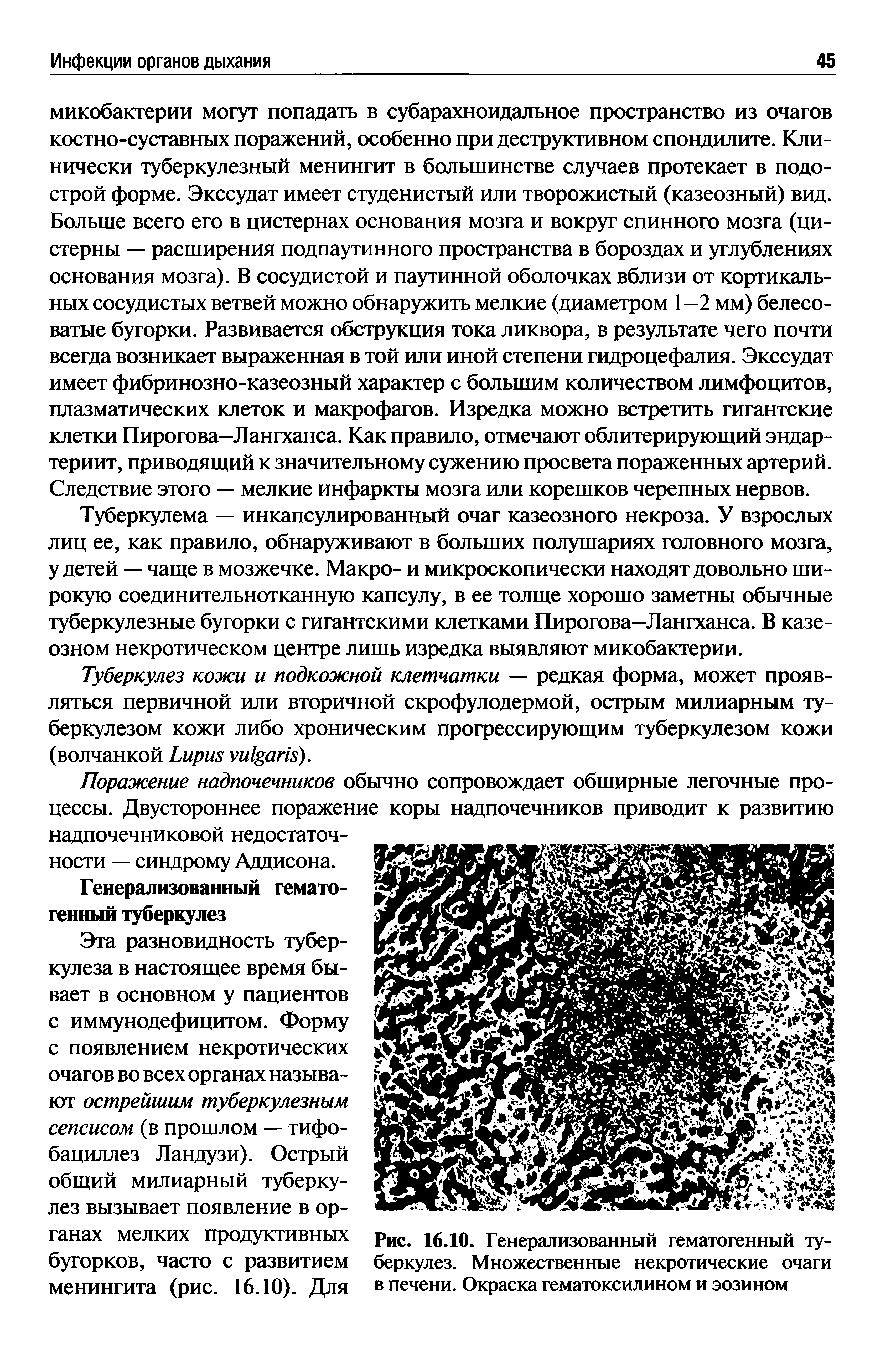 Рис. 16.10. Генерализованный гематогенный туберкулез. Множественные некротические очаги в печени. Окраска гематоксилином и эозином...