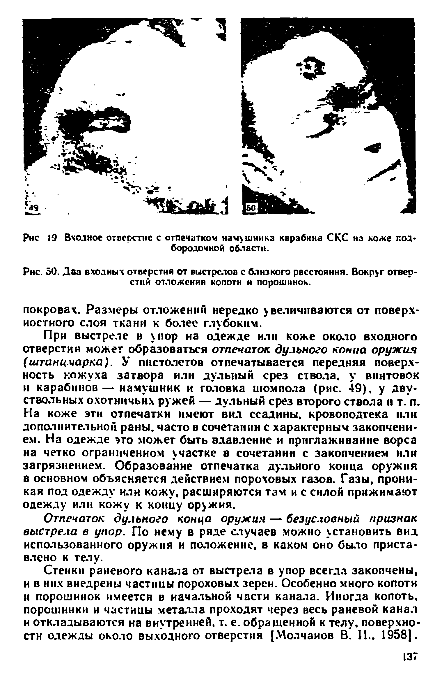 Рис. 50. Даа входных отверстия от выстрелов с близкого расстояния. Вокруг отверстий отложения копоти и порошинок.