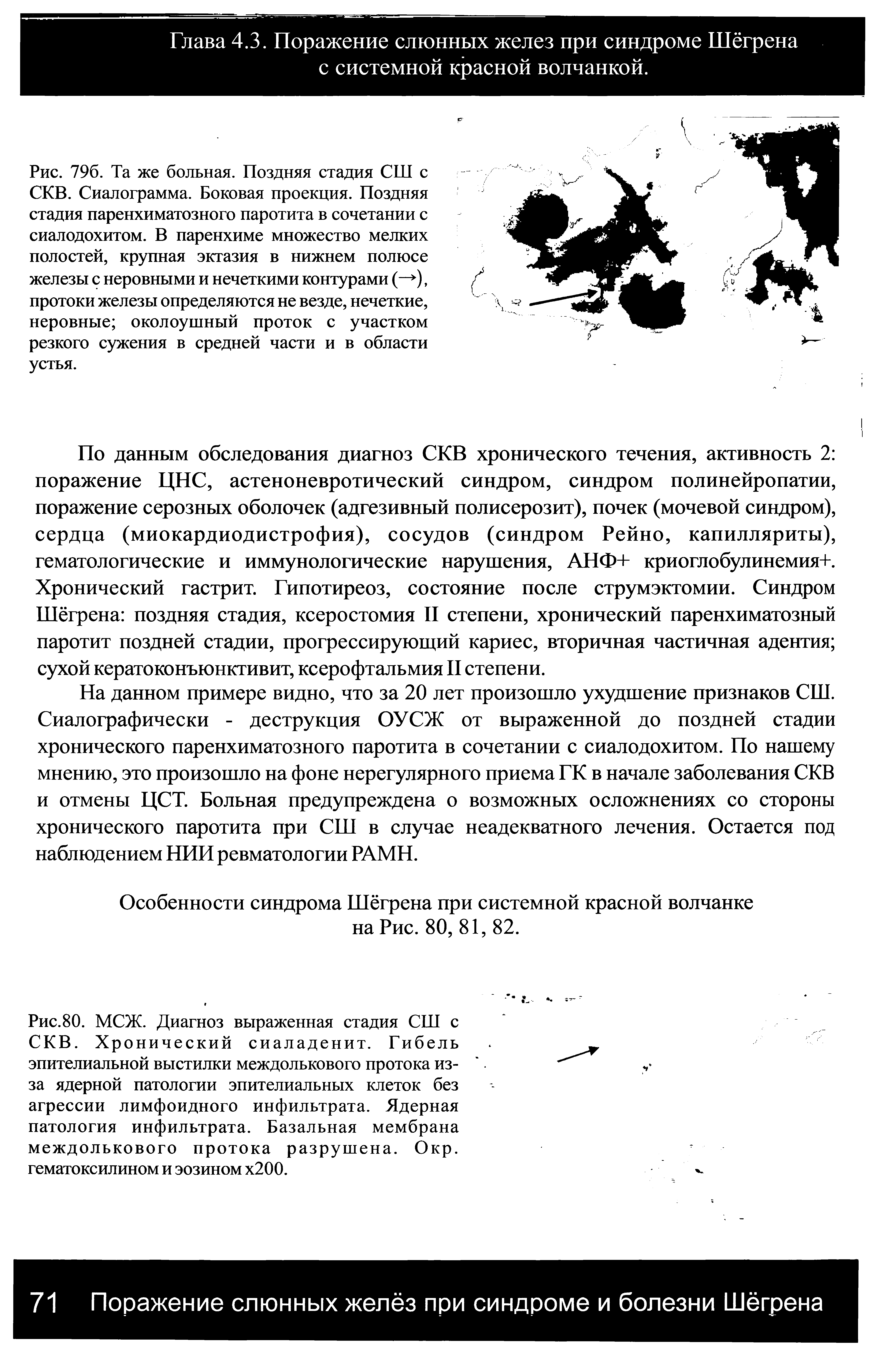 Рис.80. МСЖ. Диагноз выраженная стадия СШ с СКВ. Хронический сиаладенит. Гибель эпителиальной выстилки междолькового протока из-за ядерной патологии эпителиальных клеток без агрессии лимфоидного инфильтрата. Ядерная патология инфильтрата. Базальная мембрана междолькового протока разрушена. Окр. гематоксилином и эозином х200.