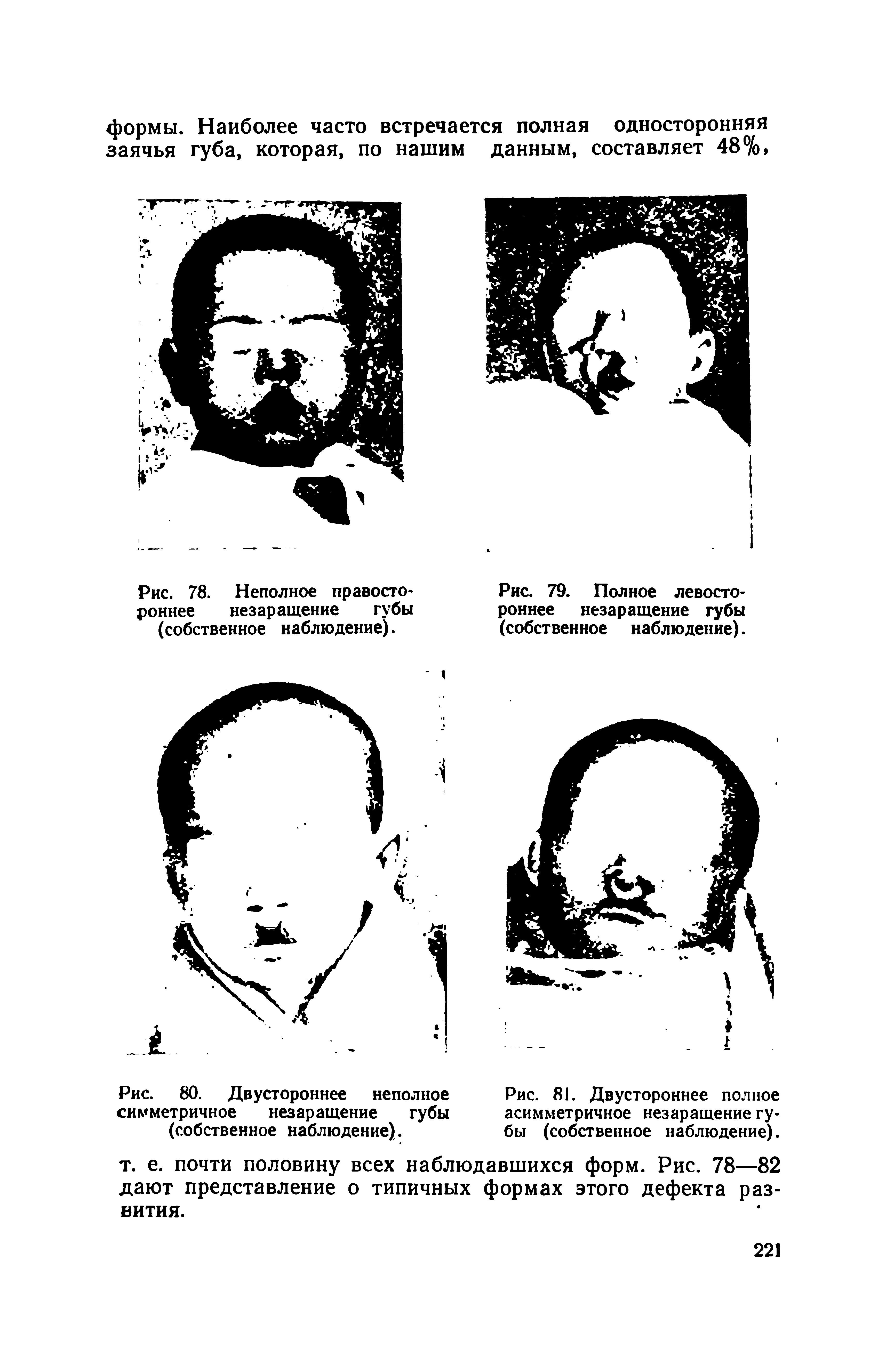 Рис. 78. Неполное правостороннее незаращение губы (собственное наблюдение).