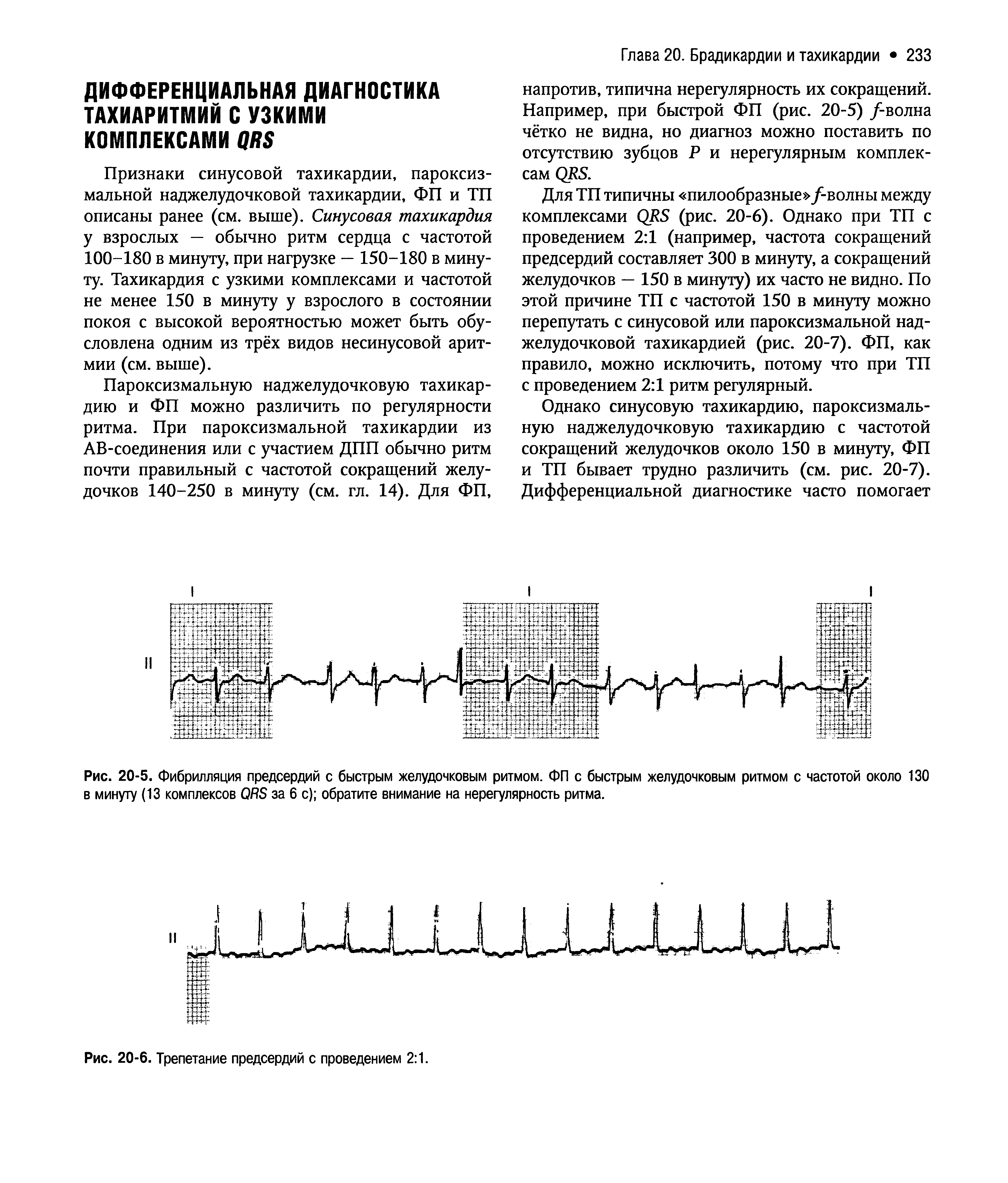 Рис. 20-5. Фибрилляция предсердий с быстрым желудочковым ритмом. ФП с быстрым желудочковым ритмом с частотой около 130 в минуту (13 комплексов (Ж) за 6 с) обратите внимание на нерегулярность ритма.