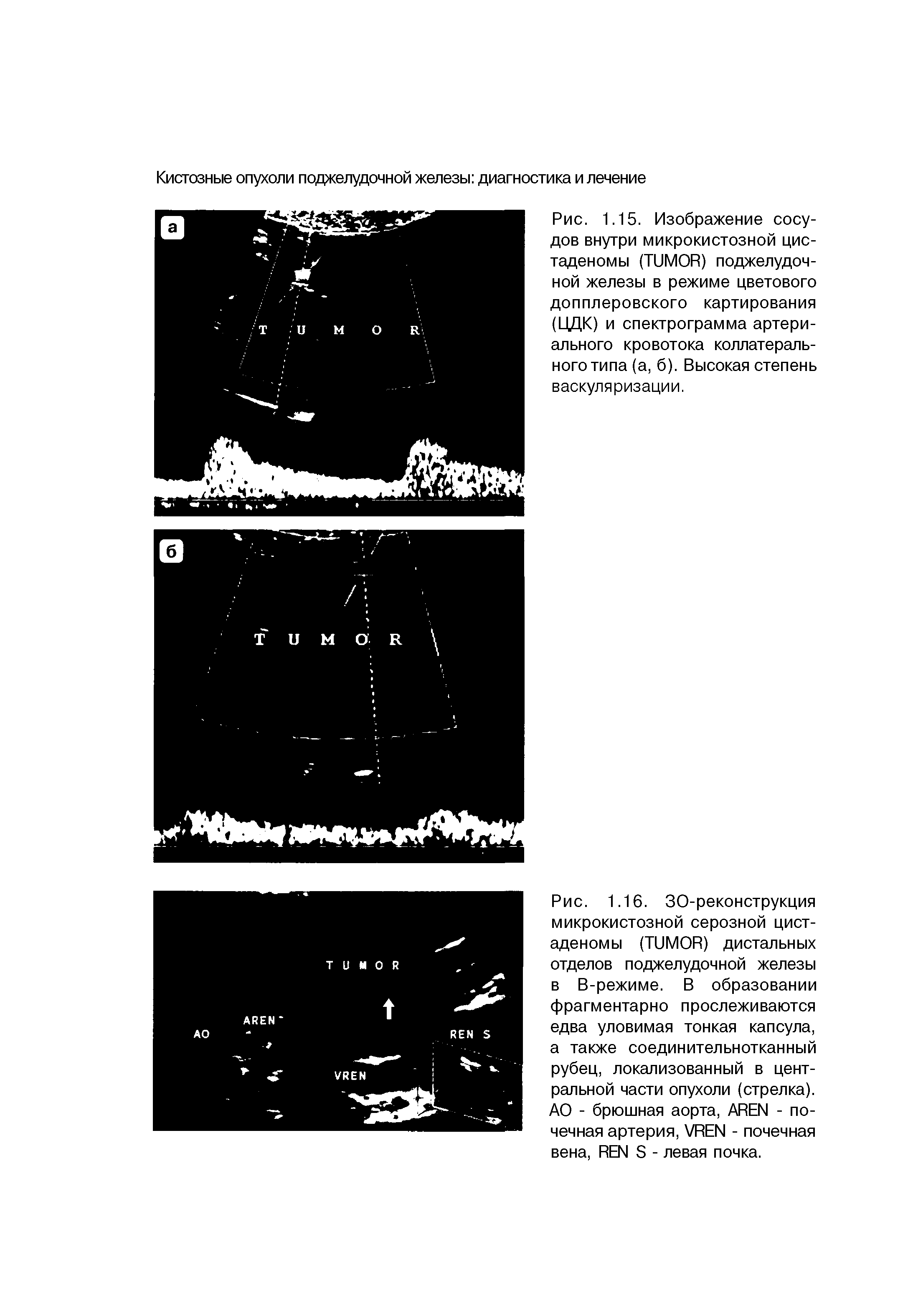 Рис. 1.15. Изображение сосудов внутри микрокистозной цис-таденомы (TUMOR) поджелудочной железы в режиме цветового допплеровского картирования (ЦДК) и спектрограмма артериального кровотока коллатерального типа (а, б). Высокая степень васкуляризации.