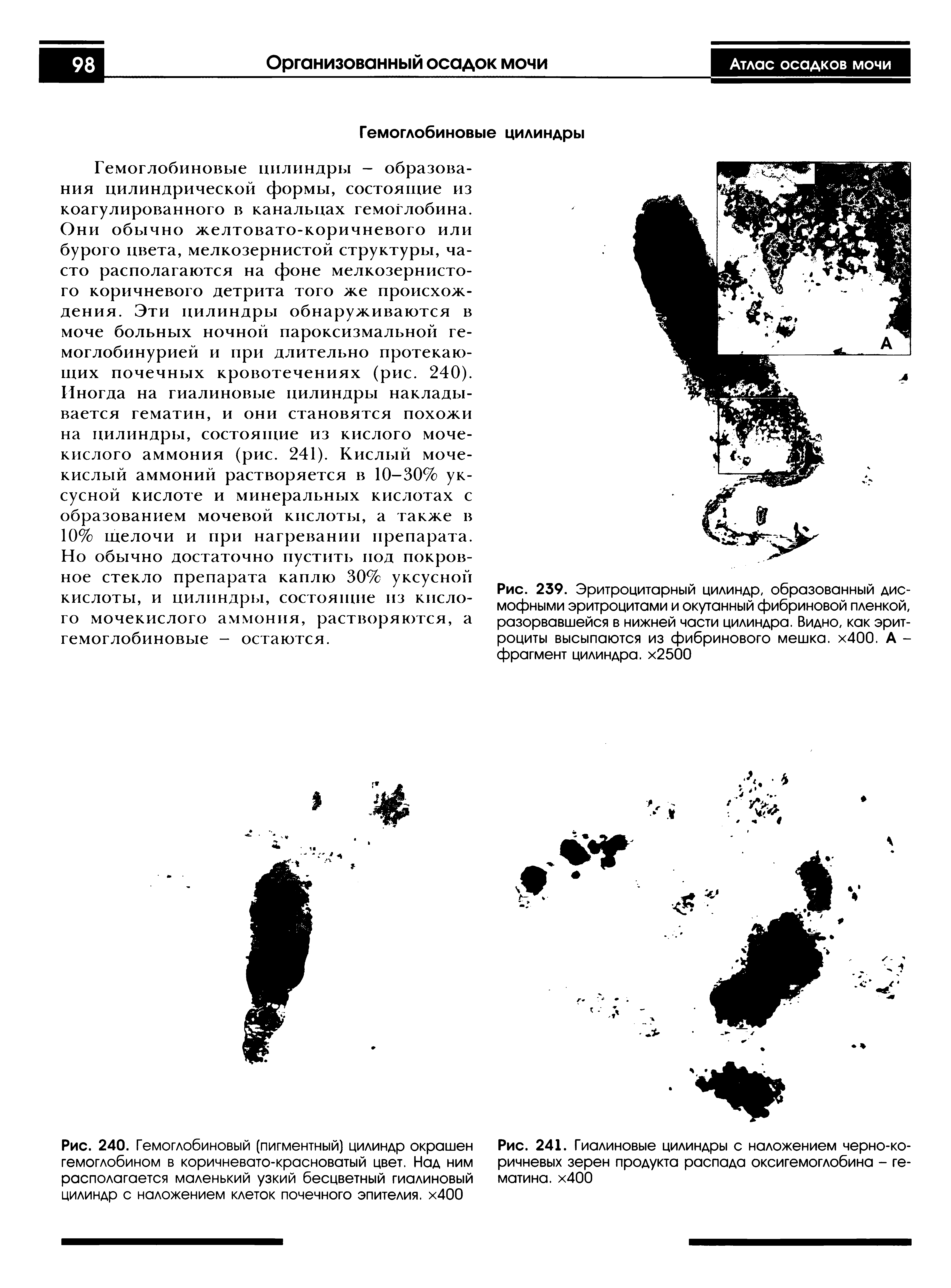 Рис. 240. Гемоглобиновый (пигментный) цилиндр окрашен гемоглобином в коричневато-красноватый цвет. Над ним располагается маленький узкий бесцветный гиалиновый цилиндр с наложением клеток почечного эпителия. х400...