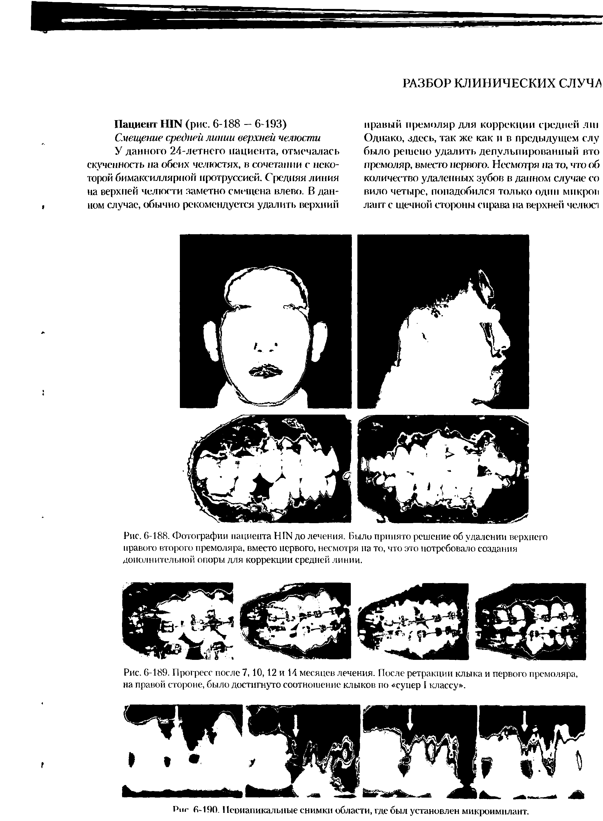 Рис. 6-188. Фотографии пациента HIN до лечения. Было принято решение об удалении верхнего правого второго премоляра, вместо первого, несмотря па то, что это потребовало создания дополнительной опоры для коррекции средней линии.