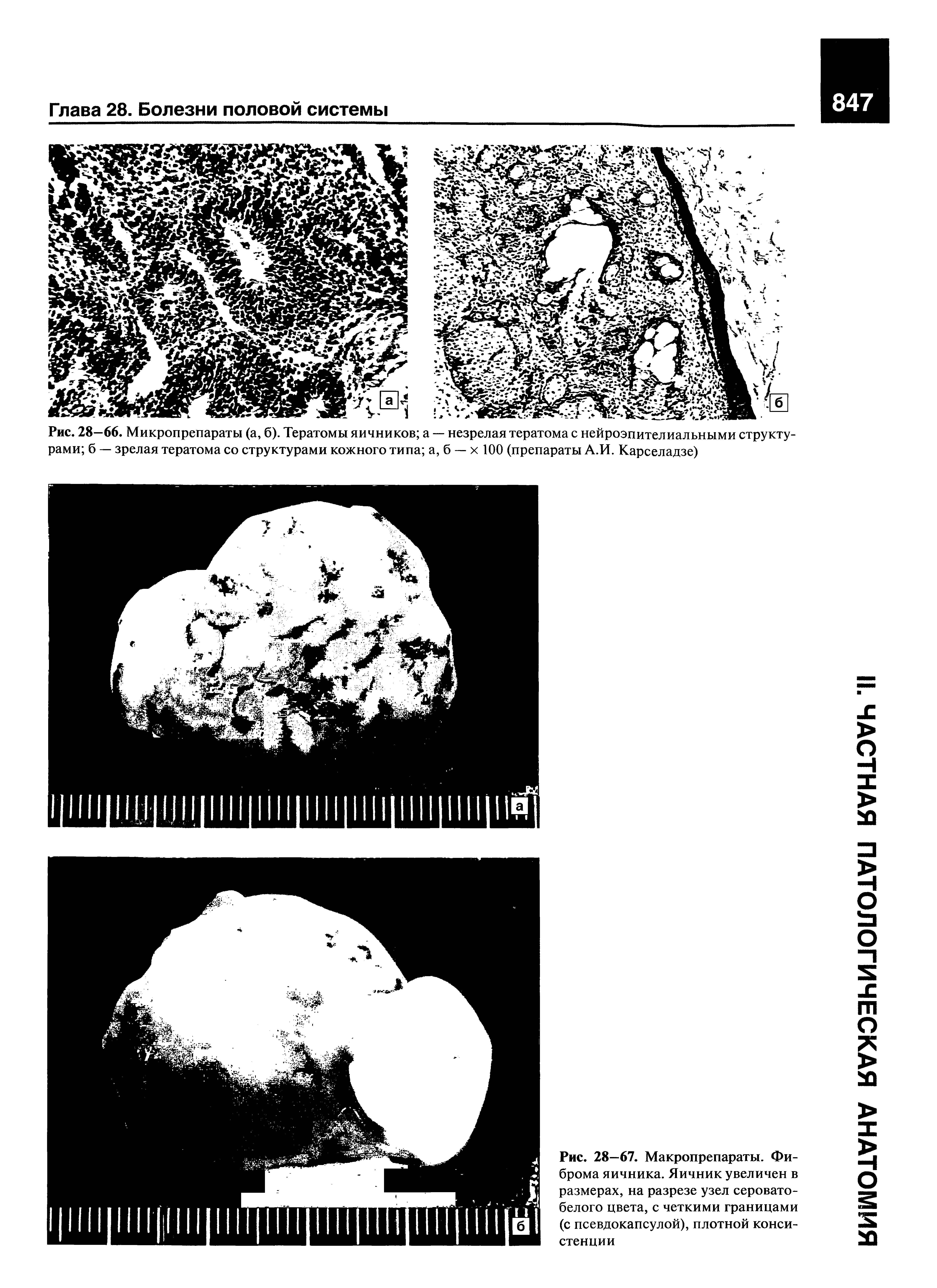 Рис. 28—67. Макропрепараты. Фиброма яичника. Яичник увеличен в размерах, на разрезе узел сероватобелого цвета, с четкими границами (с псевдокапсулой), плотной консистенции...