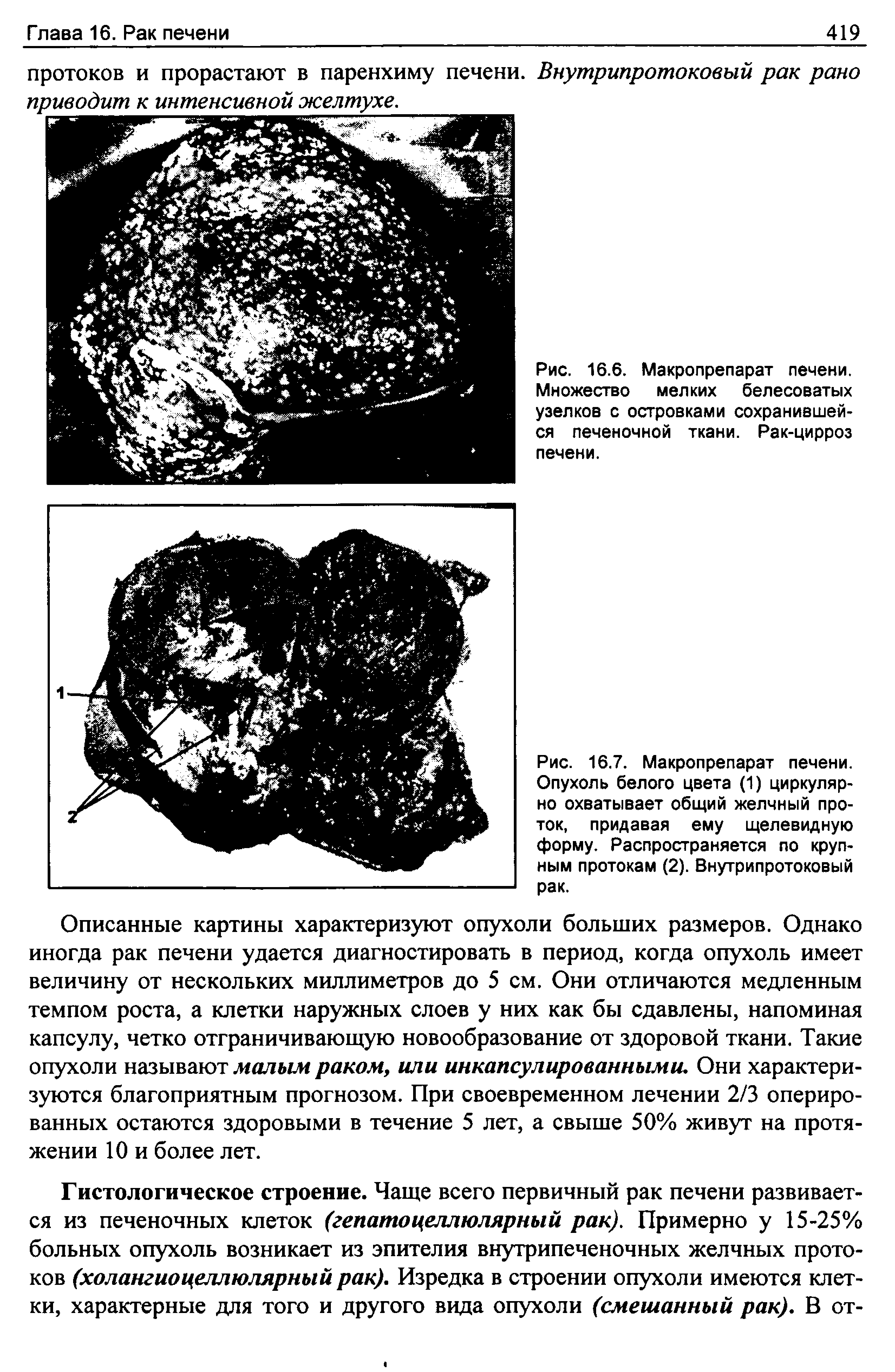 Рис. 16.6. Макропрепарат печени. Множество мелких белесоватых узелков с островками сохранившейся печеночной ткани. Рак-цирроз печени.