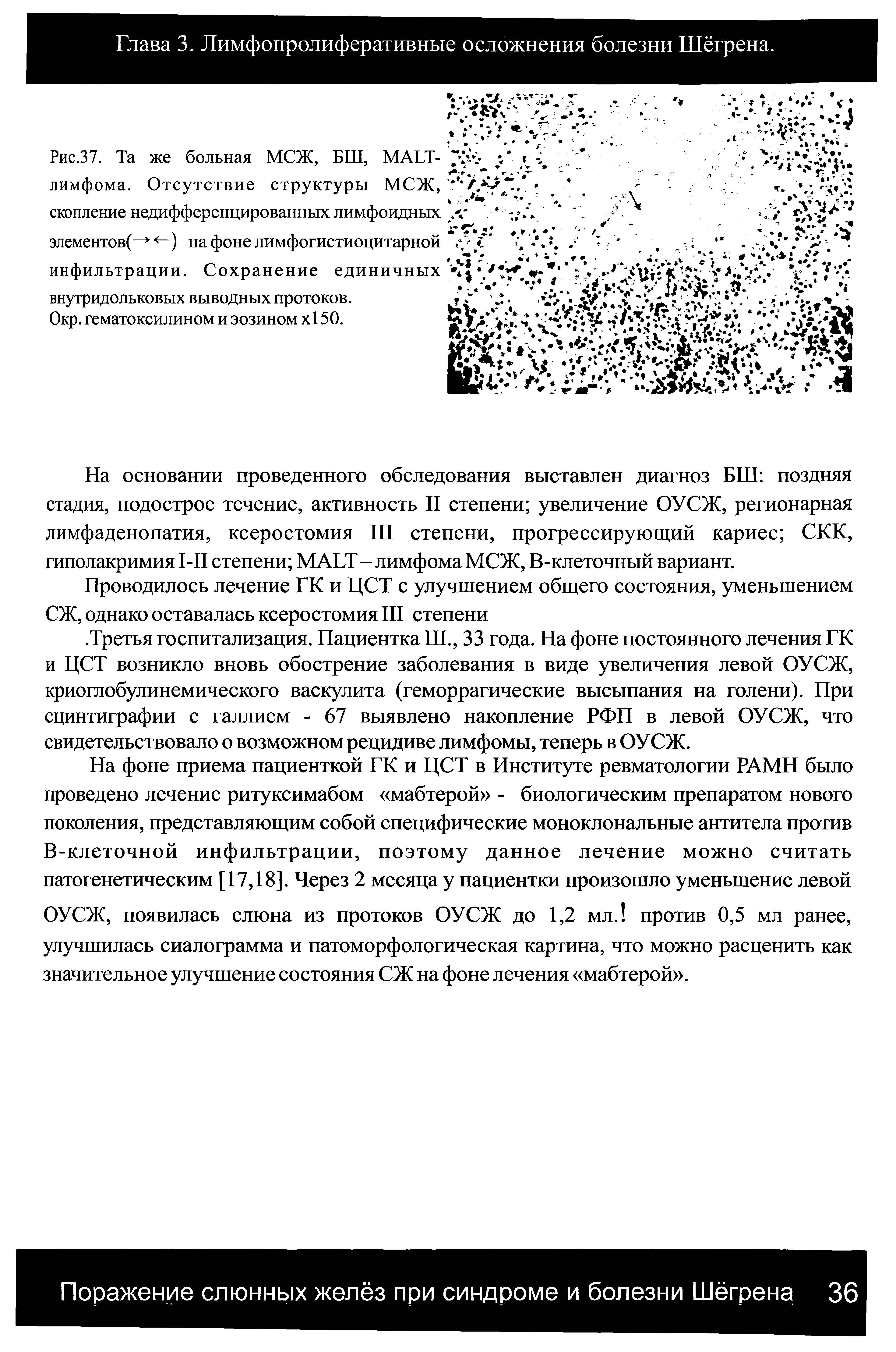 Рис.37. Та же больная МСЖ, БШ, МАЬТ-лимфома. Отсутствие структуры МСЖ, скопление недифференцированных лимфоидных элементов( —) на фоне лимфогистиоцитарной инфильтрации. Сохранение единичных внутридольковых выводных протоков.