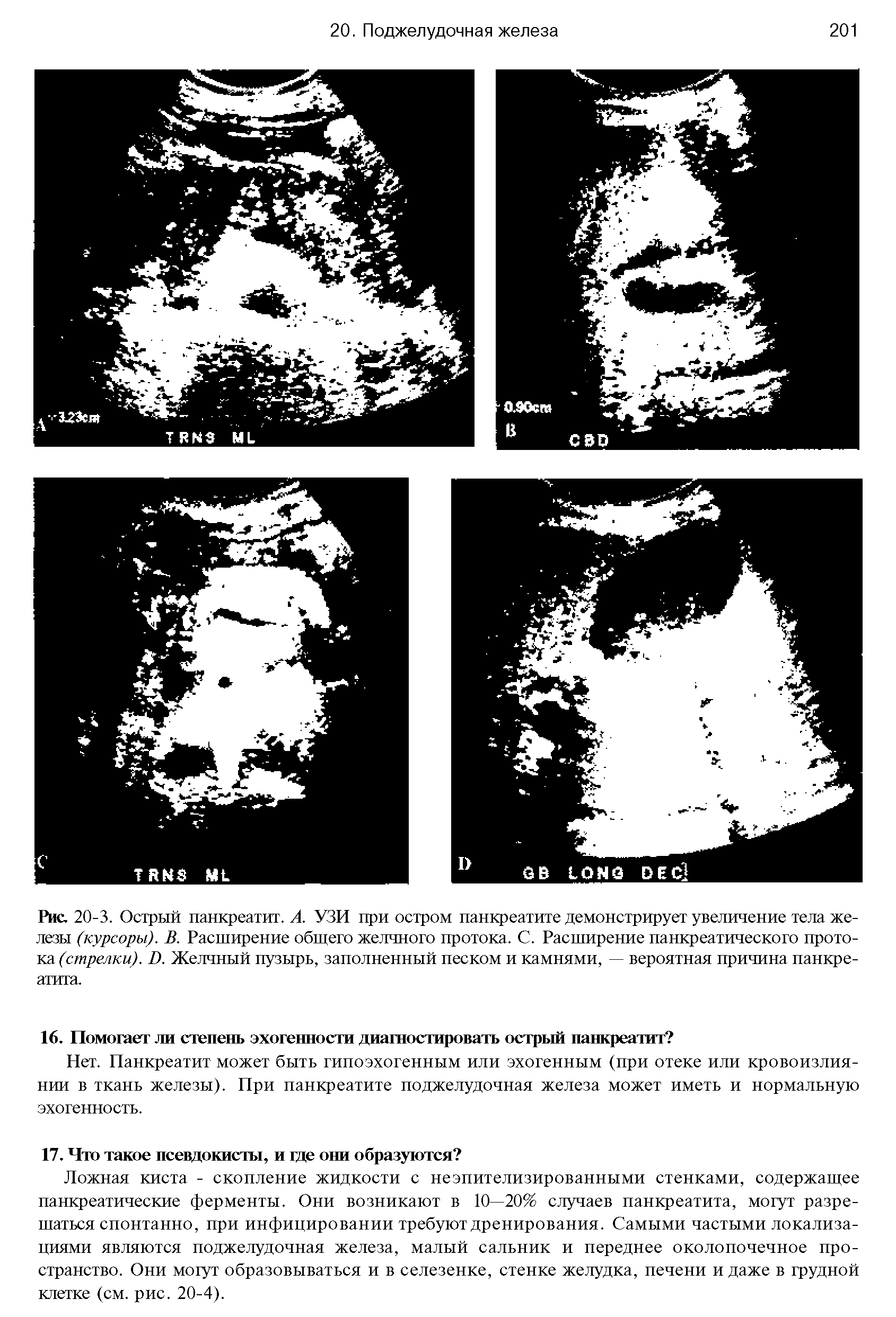 Рис. 20-3. Острый панкреатит. А. УЗИ при остром панкреатите демонстрирует увеличение тела железы (курсоры). В. Расширение общего желчного протока. С. Расширение панкреатического протока (стрелки). Б. Желчный пузырь, заполненный песком и камнями, — вероятная причина панкреатита.