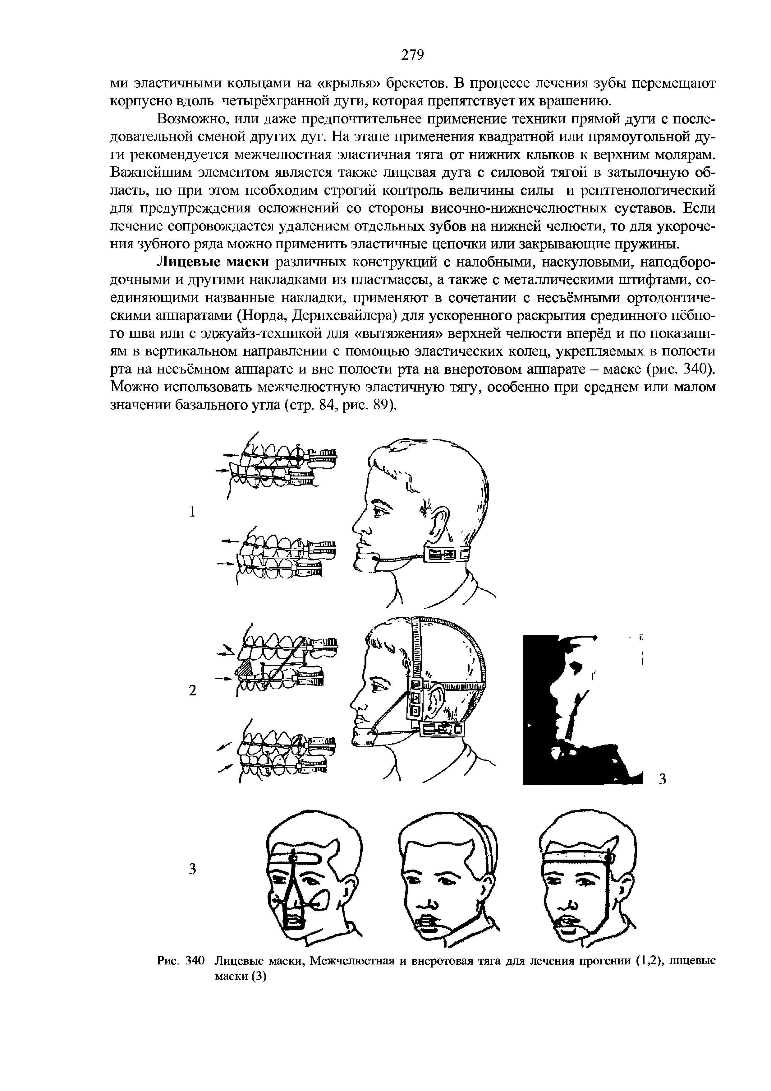 Рис. 340 Лицевые маски, Межчелюстная и внеротовая тяга для лечения прогении (1,2), лицевые маски (3)...