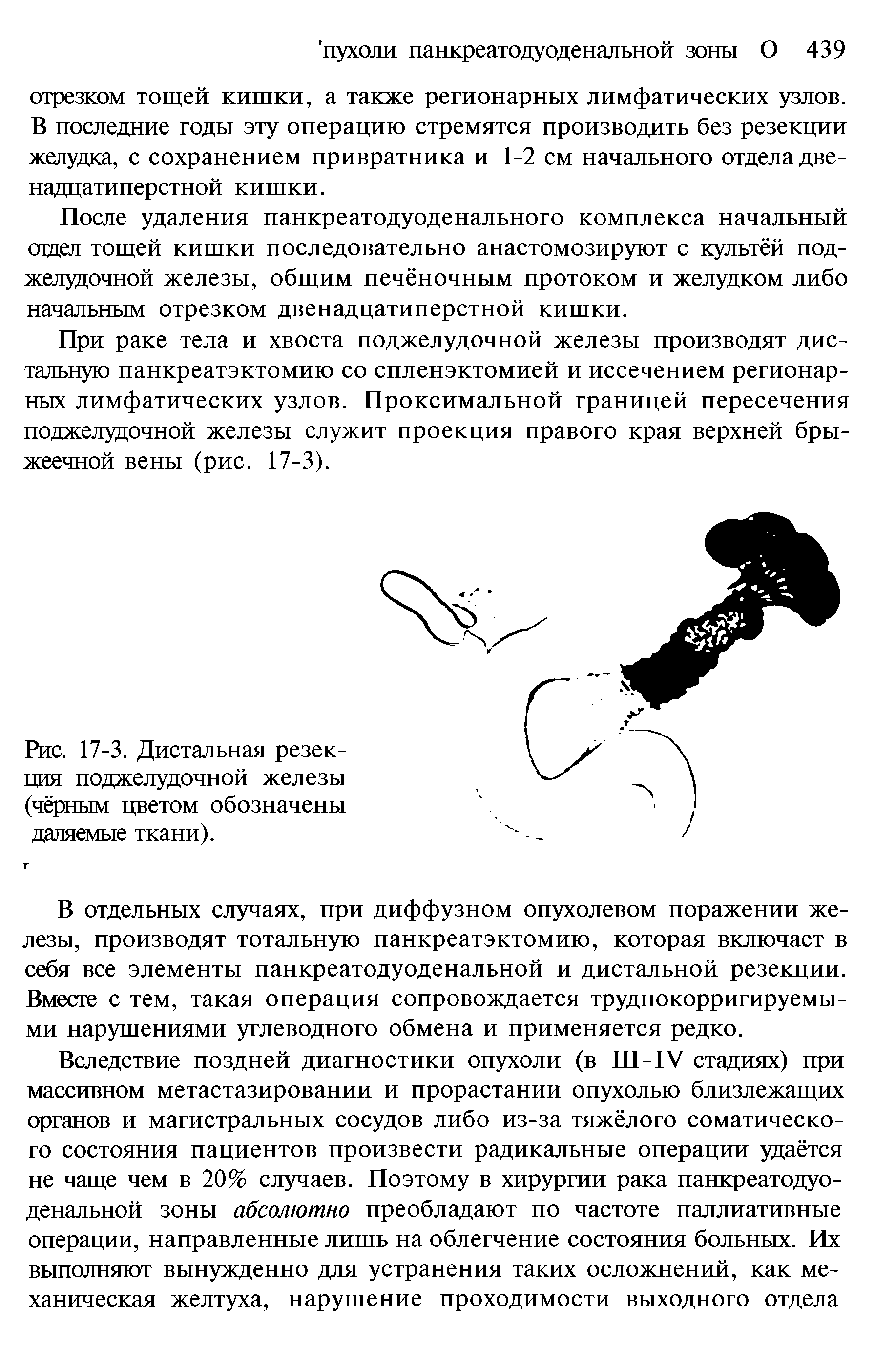 Рис. 17-3. Дистальная резекция поджелудочной железы (чёрным цветом обозначены даляемые ткани).