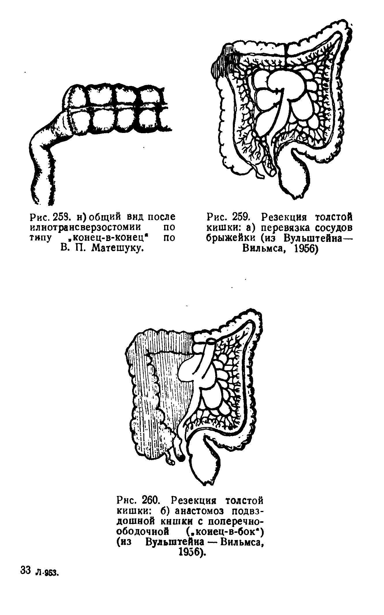Рис. 260. Резекция толстой кишки б) анастомоз подвздошной кишки с поперечноободочной (,коиец-в-бок ) (из Вульштейна — Вильмса.