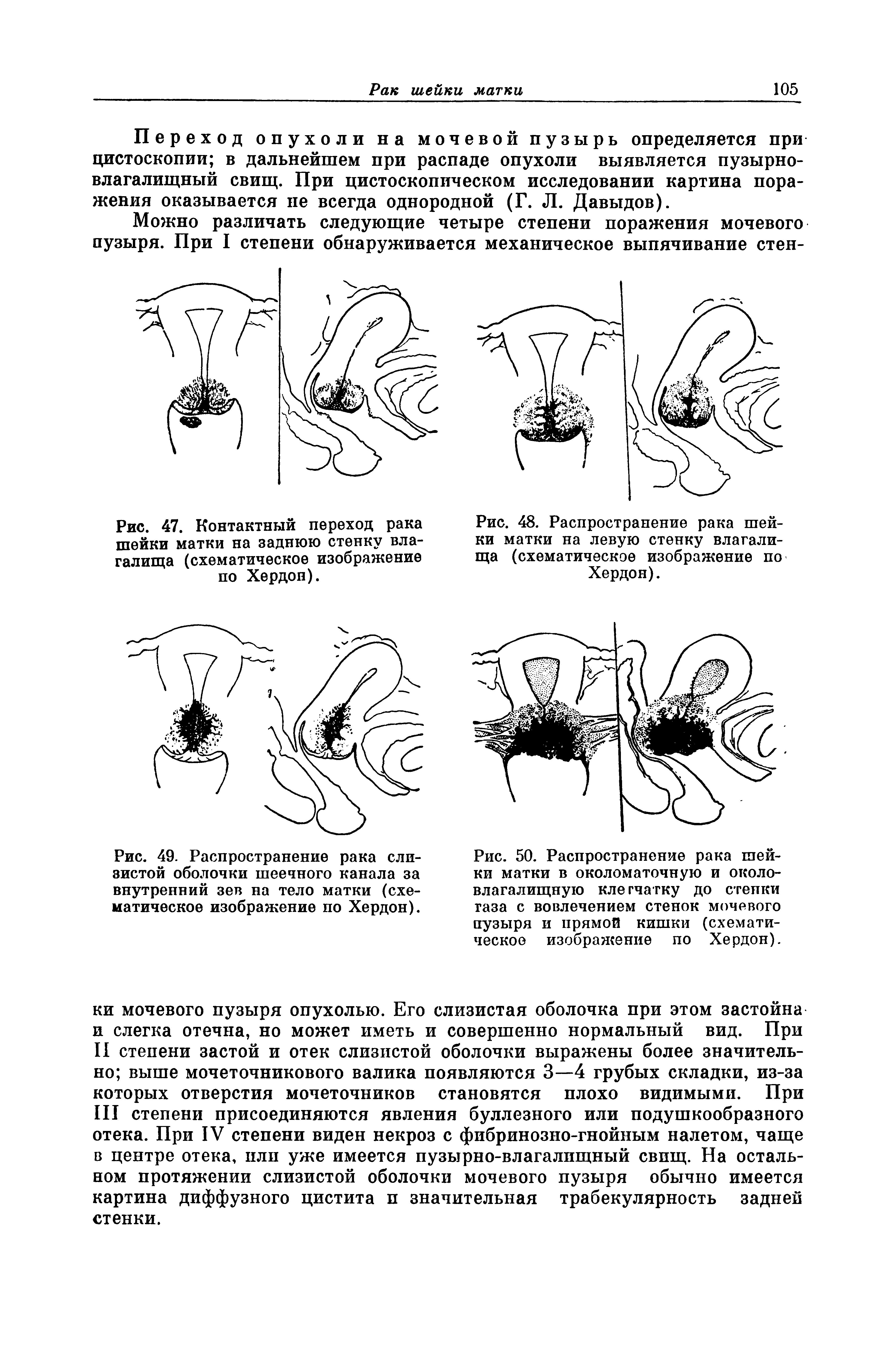 Рис. 49. Распространение рака слизистой оболочки шеечного канала за внутренний зев на тело матки (схематическое изображение по Хердон).