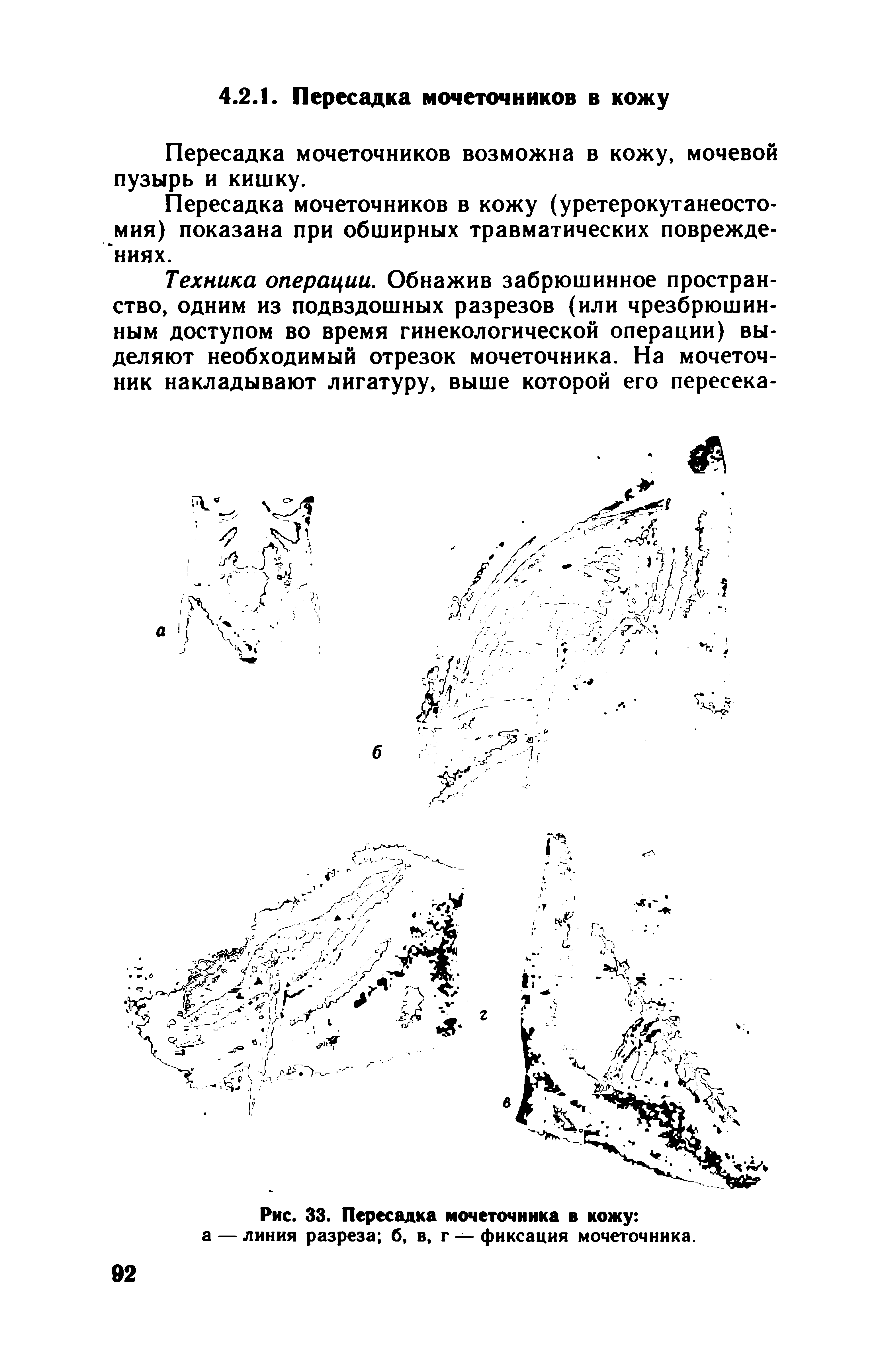 Рис. 33. Пересадка мочеточника в кожу а — линия разреза б, в, г — фиксация мочеточника.