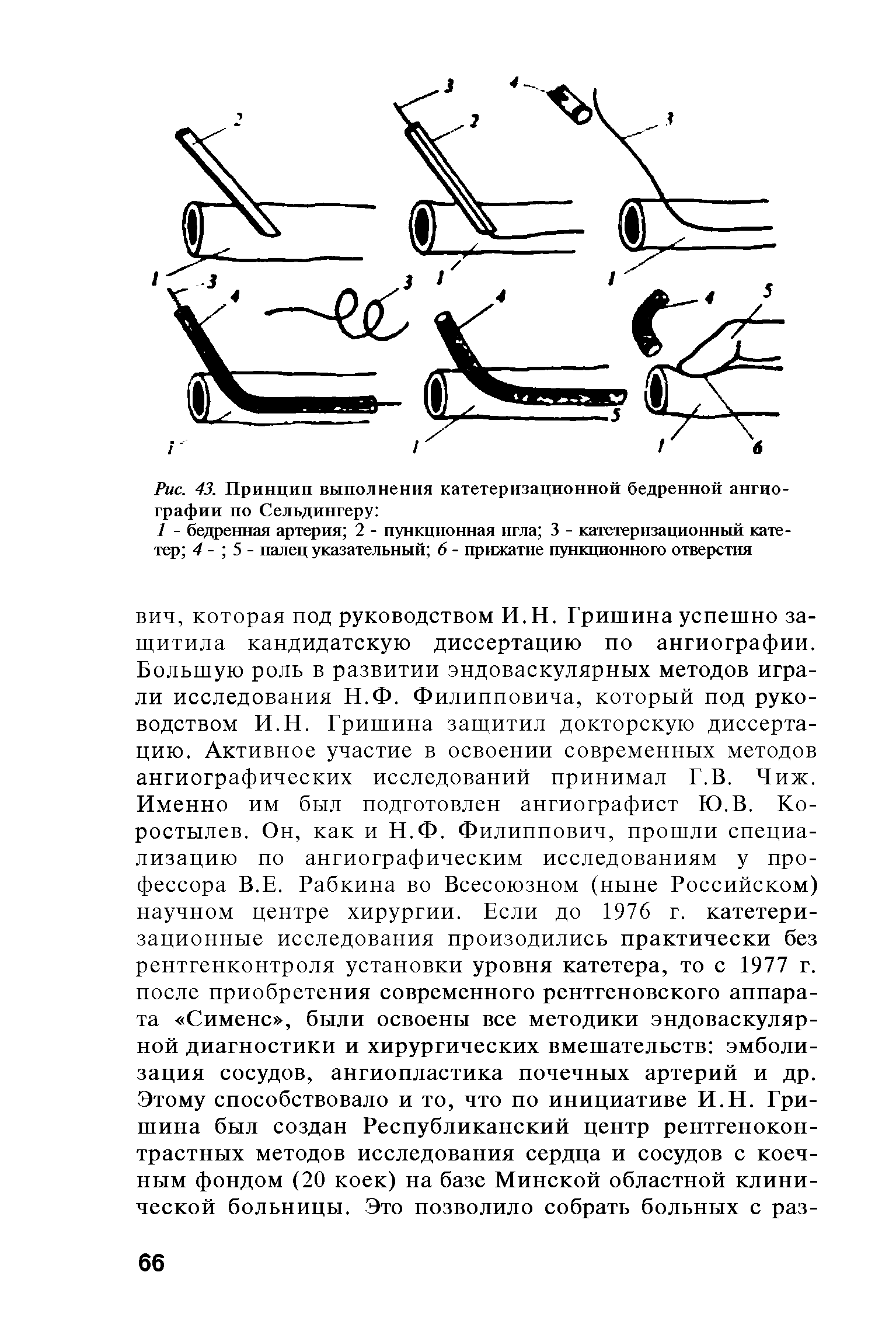 Рис. 43. Принцип выполнения катетеризационной бедренной ангиографии по Сельдингеру ...