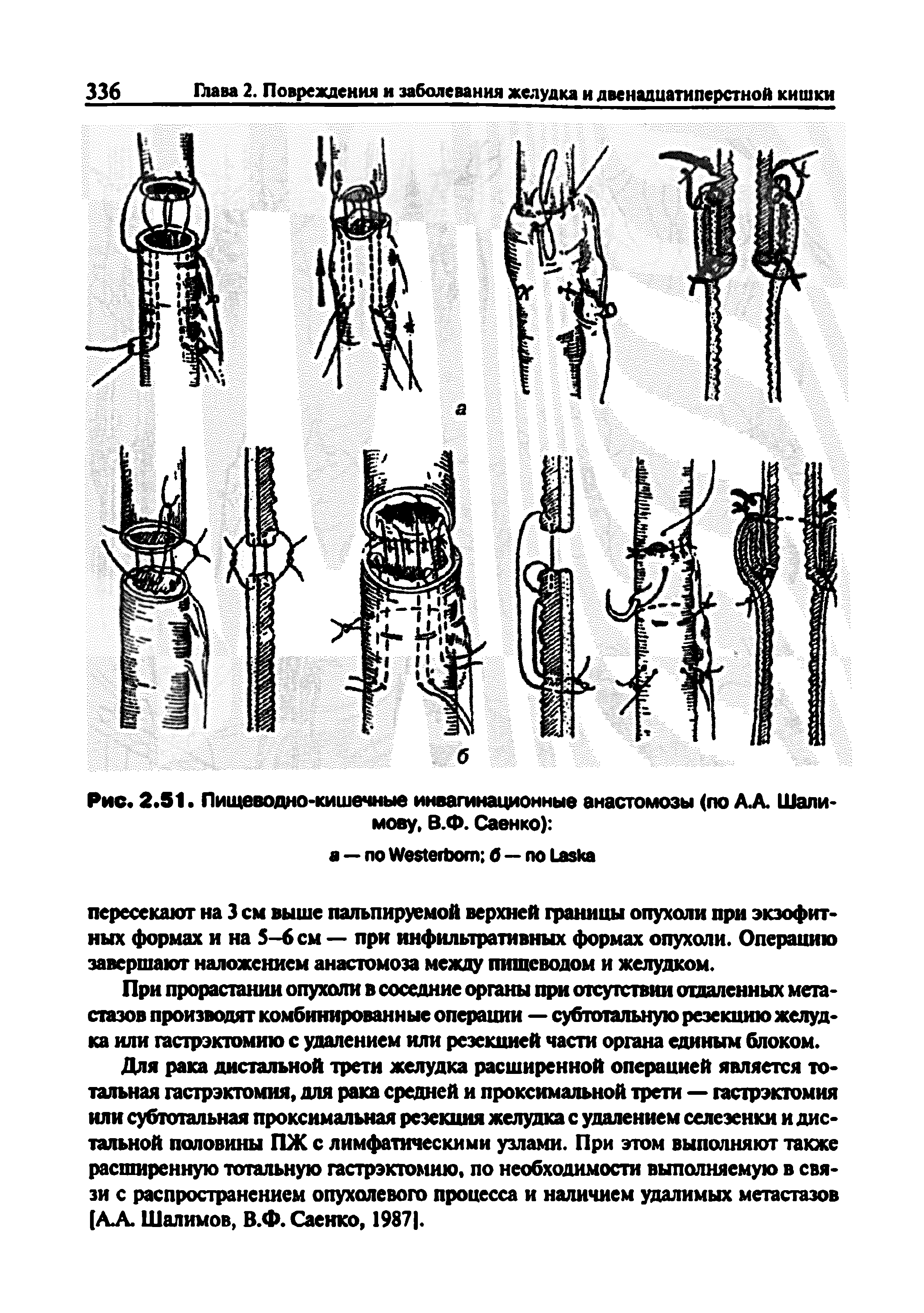 Рис. 2.51. Пищеводно-кишечные инвагинационные анастомозы (по АЛ Шалимову, В.Ф. Саенко) ...