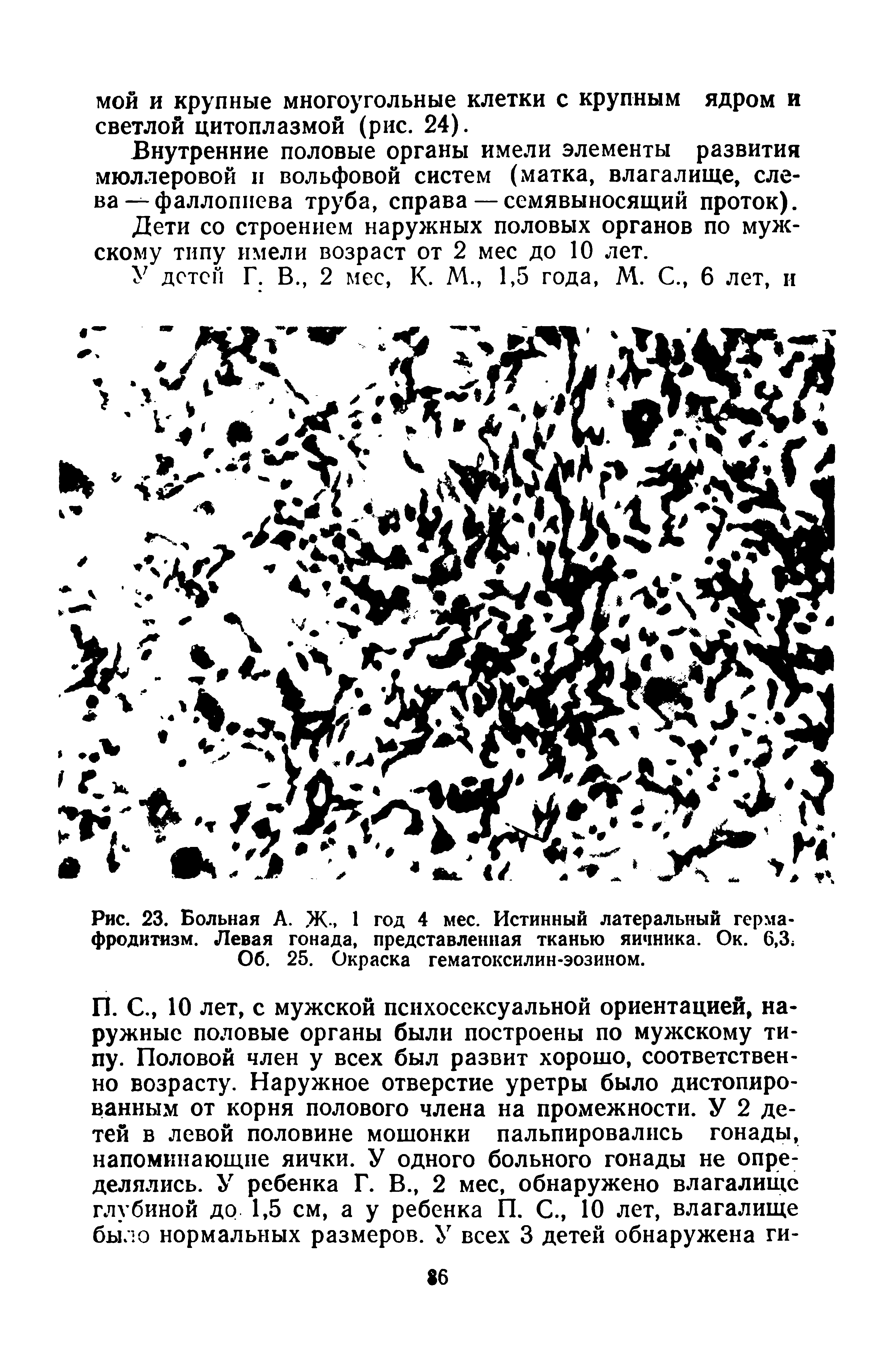 Рис. 23. Больная А. Ж-, 1 год 4 мес. Истинный латеральный гермафродитизм. Левая гонада, представленная тканью яичника. Ок. 6,3 ...