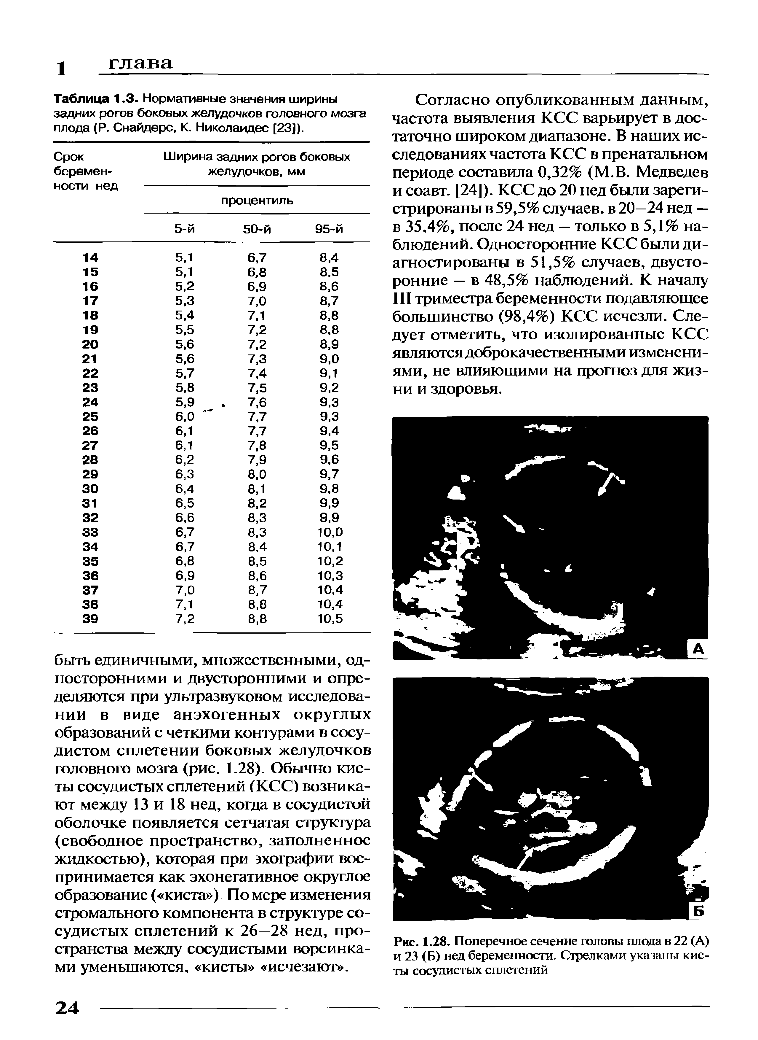 Таблица 1.3. Нормативные значения ширины задних рогов боковых желудочков головного мозга плода (Р. Снайдере, К. Николаидес [23]).