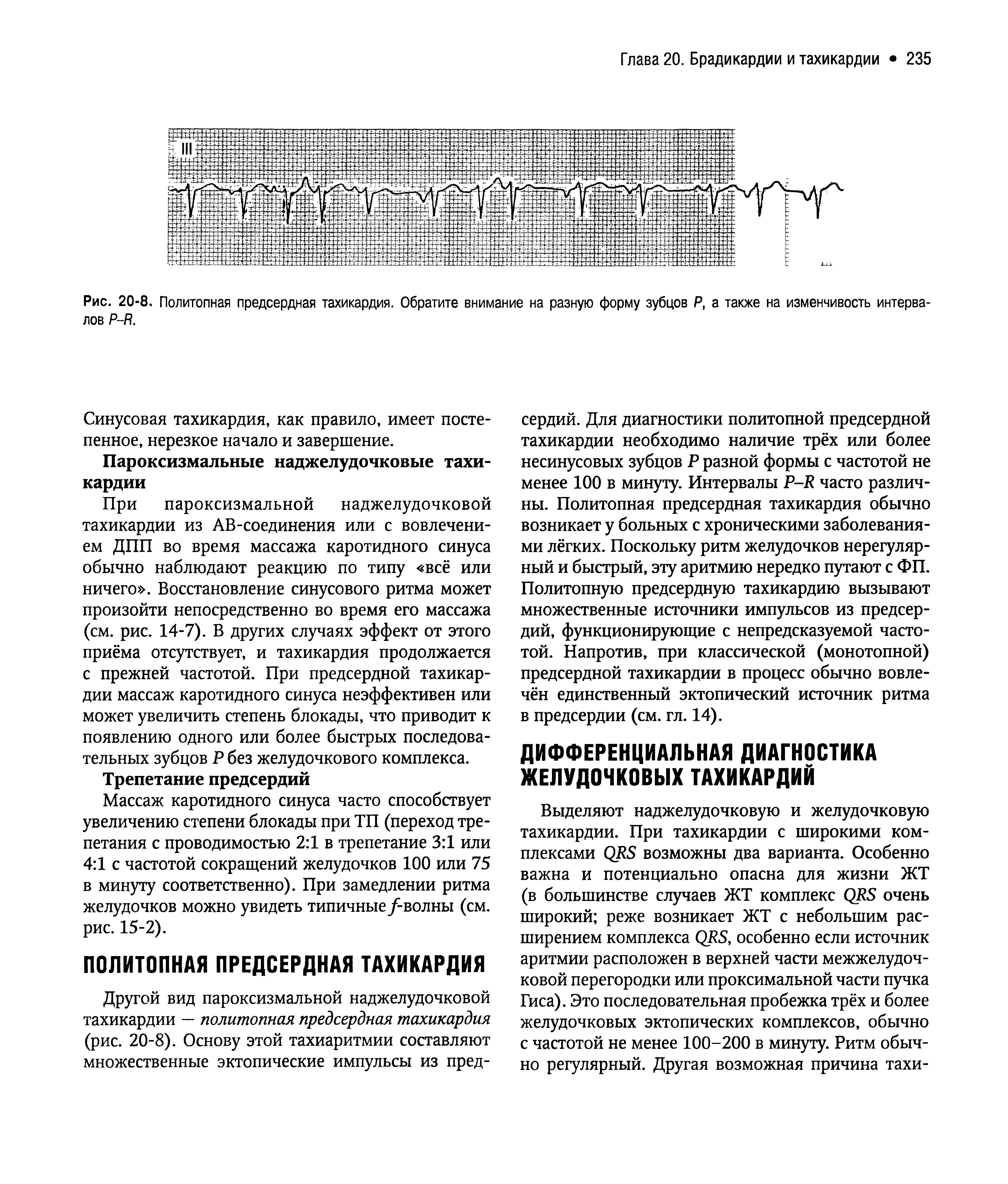 Рис. 20-8. Политопная предсердная тахикардия. Обратите внимание на разную форму зубцов Р, а также на изменчивость интервалов Р-Я.