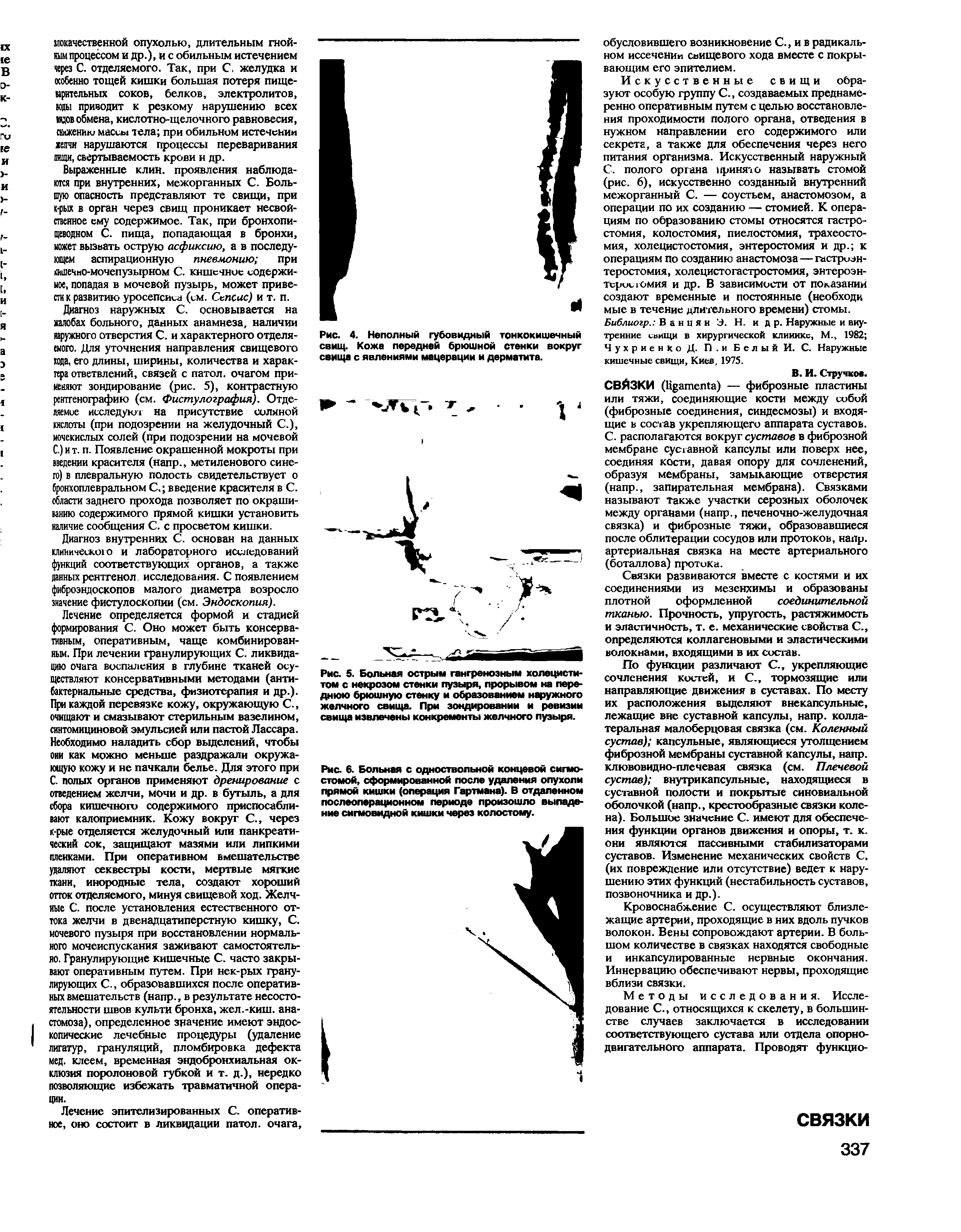 Рис. 6. Больная с одноствольной концевой сигмо-стомой, сформированной после удаления опухоли прямой кишки (операция Гартмана). В отдаленном послеоперационном периоде произошло выпадение ситовидной кишки через холостому.