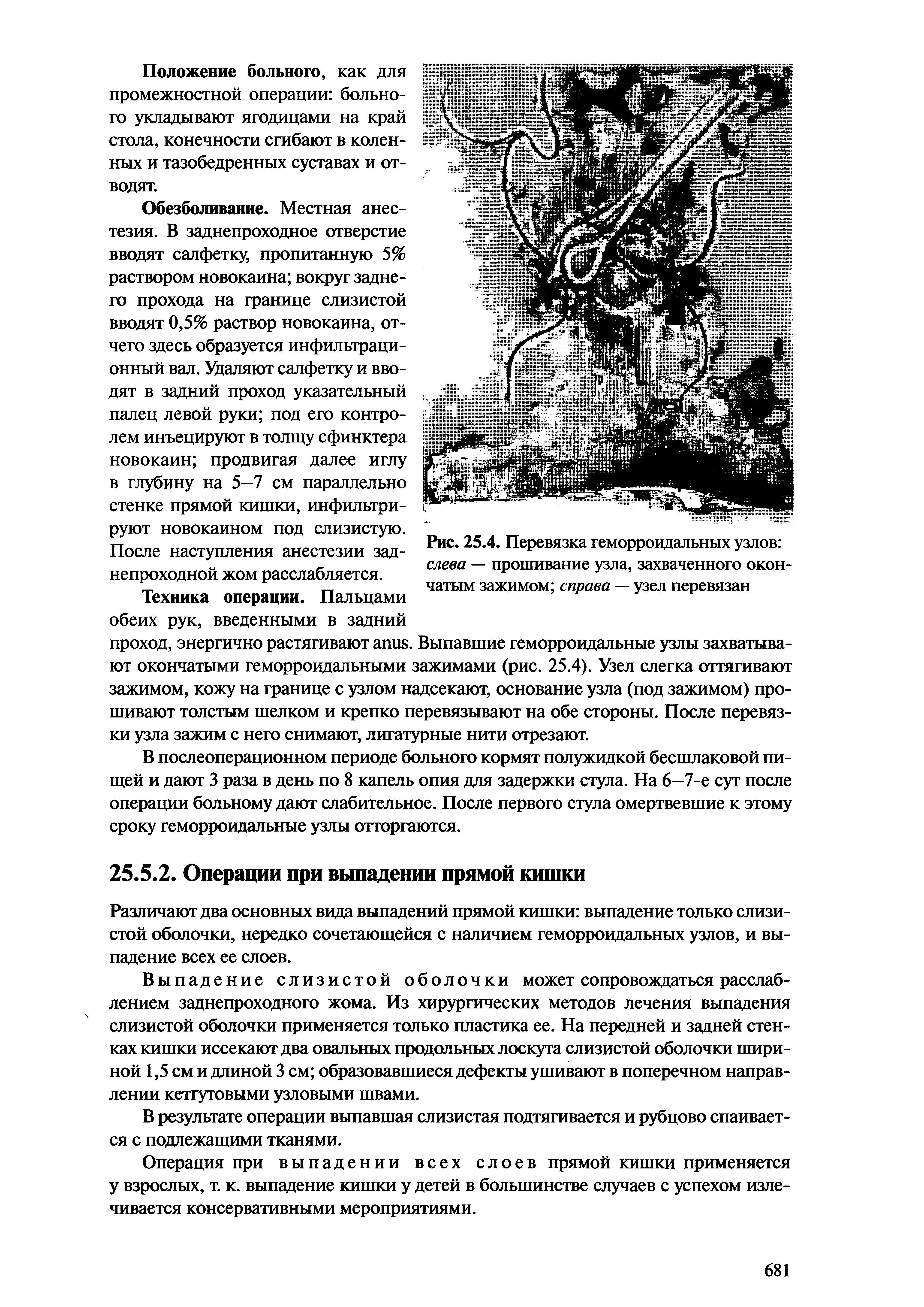 Рис. 25.4. Перевязка геморроидальных узлов слева — прошивание узла, захваченного окон-чатым зажимом справа — узел перевязан...