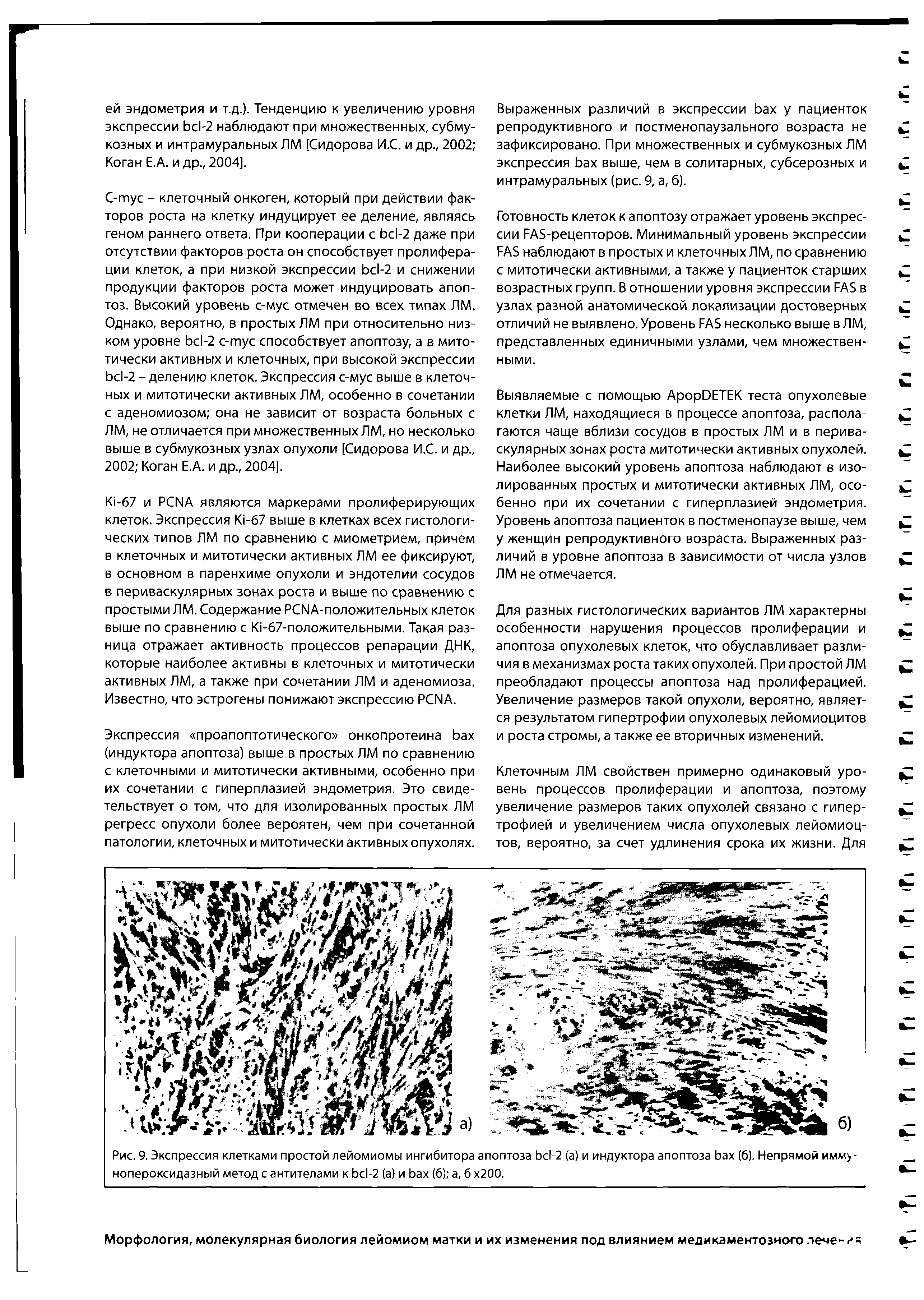 Рис. 9. Экспрессия клетками простой лейомиомы ингибитора апоптоза Ьс1-2 (а) и индуктора апоптоза Ьах (б). Непрямой имму-нопероксидазный метод с антителами к Ьс1-2 (а) и Ьах (б) а, б х200.