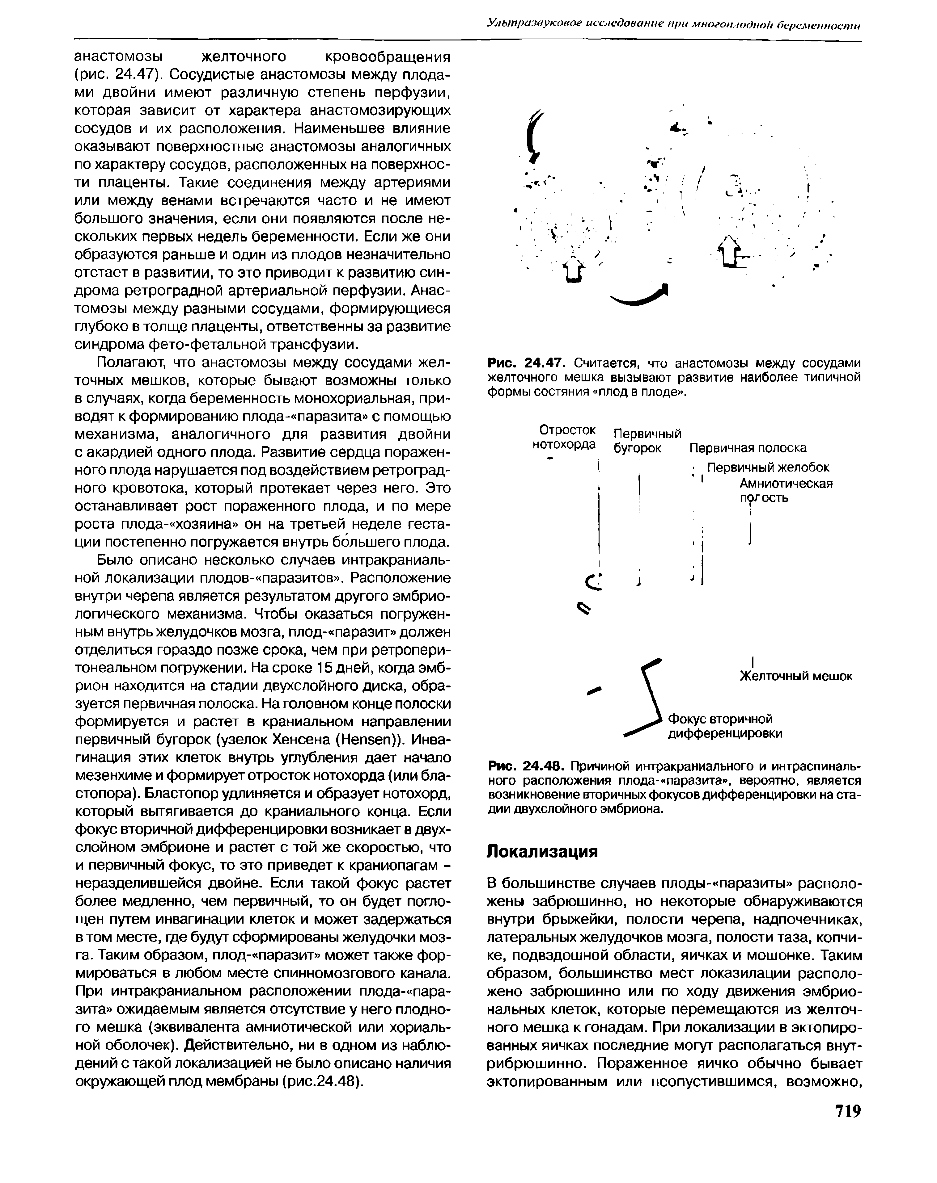 Рис. 24.47. Считается, что анастомозы между сосудами желточного мешка вызывают развитие наиболее типичной формы состяния плод в плоде .