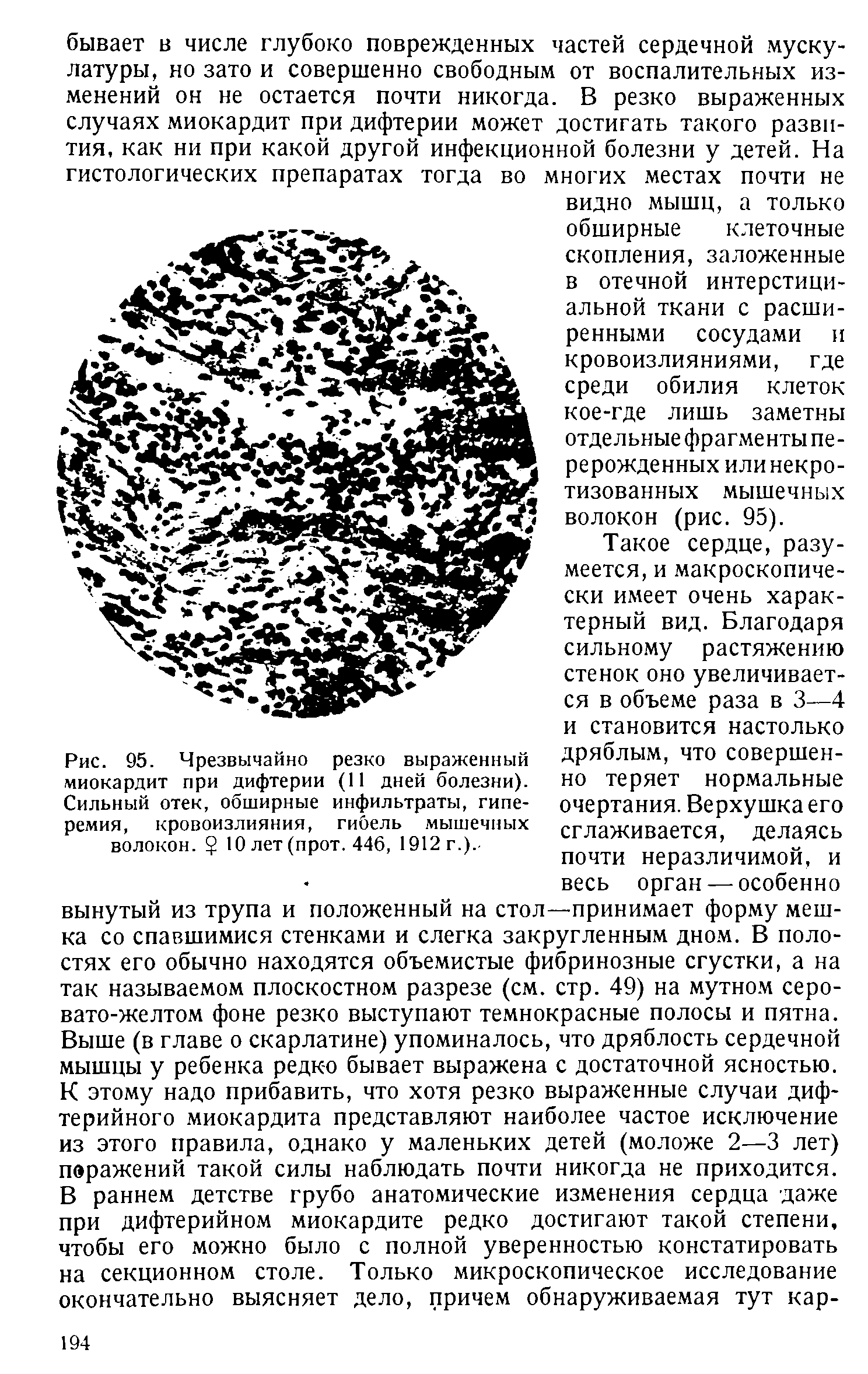 Рис. 95. Чрезвычайно резко выраженный миокардит при дифтерии (11 дней болезни). Сильный отек, обширные инфильтраты, гиперемия, кровоизлияния, гибель мышечных волокон. 10 лет (прот. 446, 1912г.).