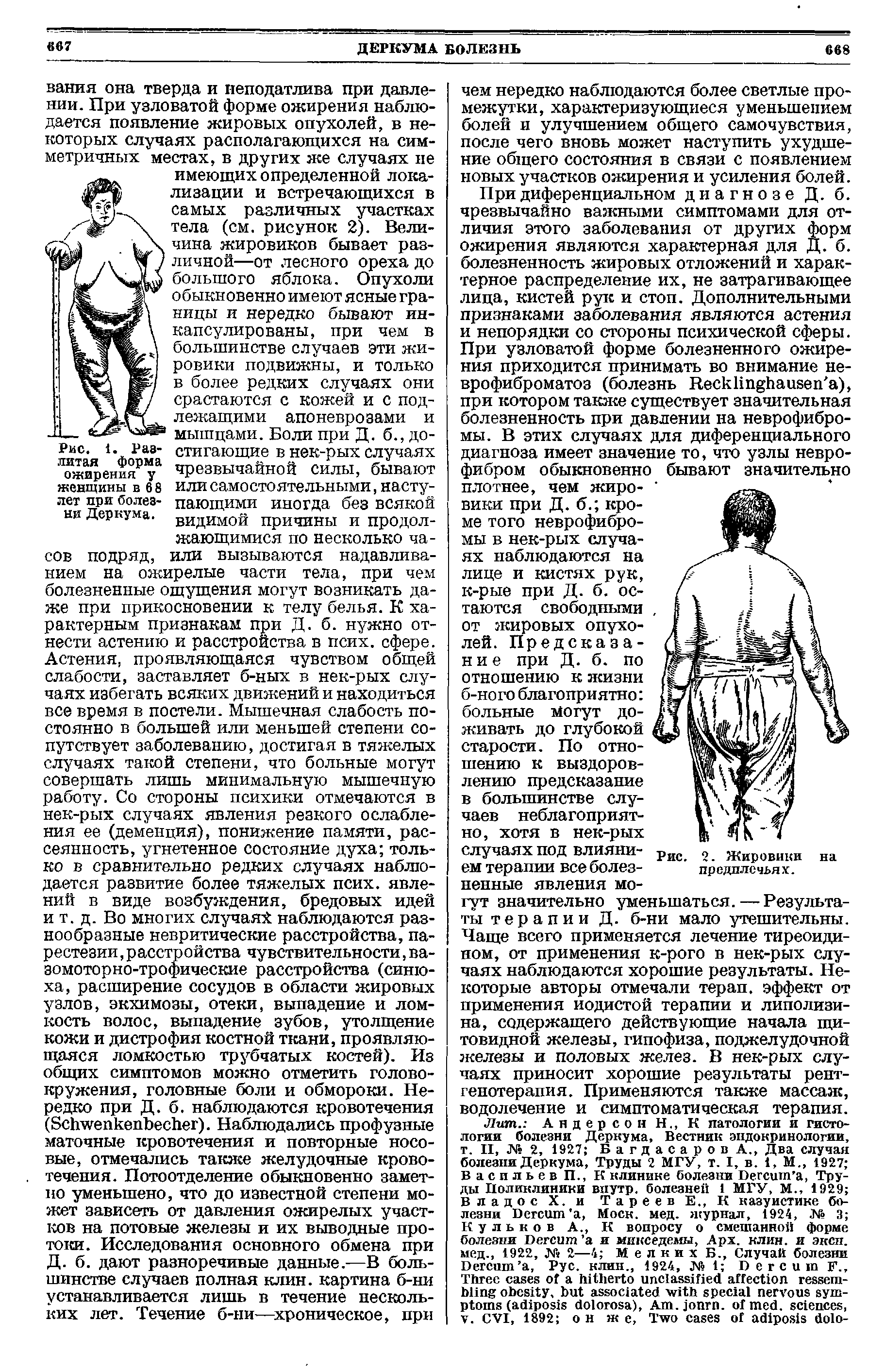 Рис. 1. Разлитая форма ожирения у женщины в 6 8 пет при болезни Деркума.