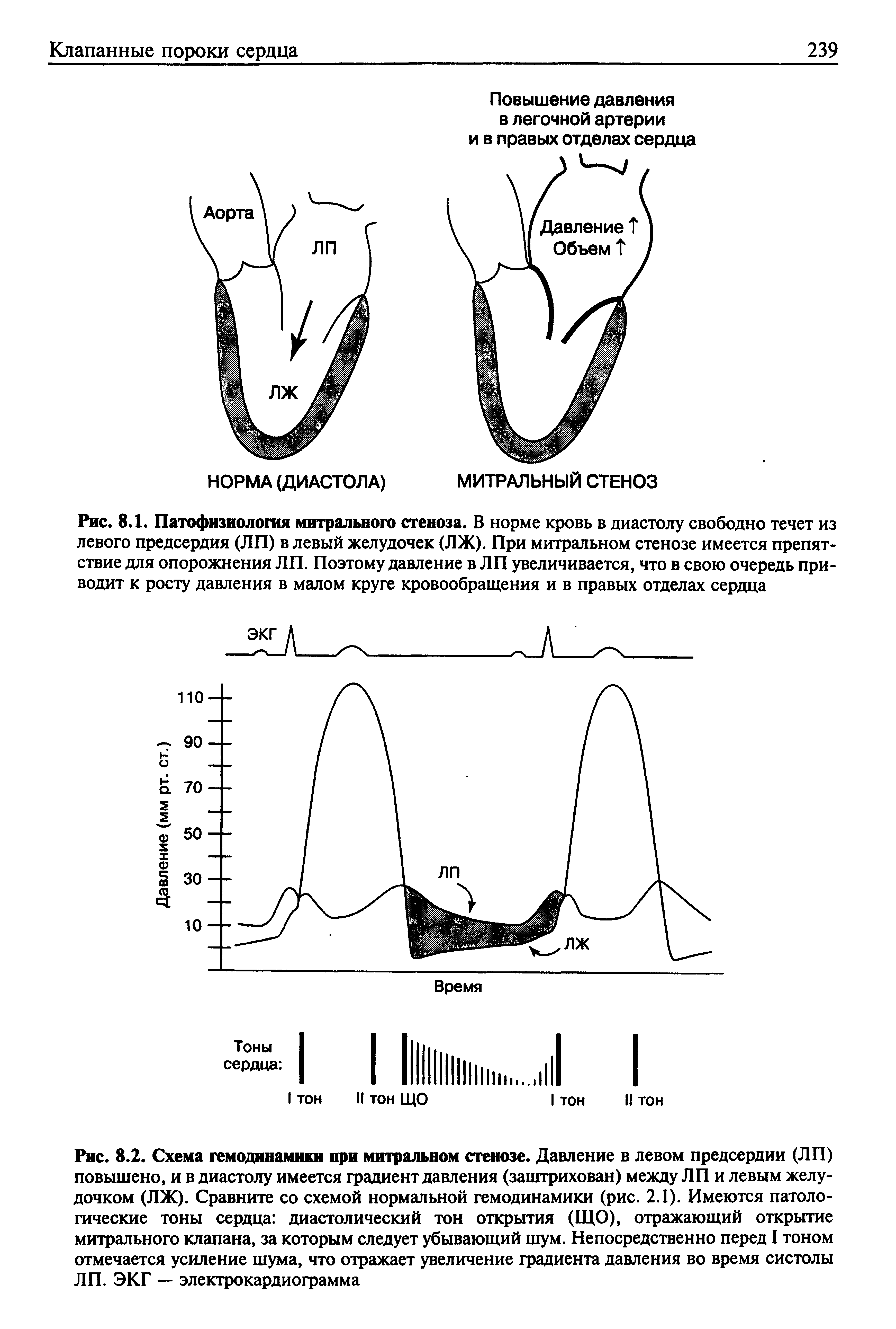Рис. 8.1. Патофизиология митрального стеноза. В норме кровь в диастолу свободно течет из левого предсердия (ЛП) в левый желудочек (ЛЖ). При митральном стенозе имеется препятствие для опорожнения ЛП. Поэтому давление в ЛП увеличивается, что в свою очередь приводит к росту давления в малом круге кровообращения и в правых отделах сердца...