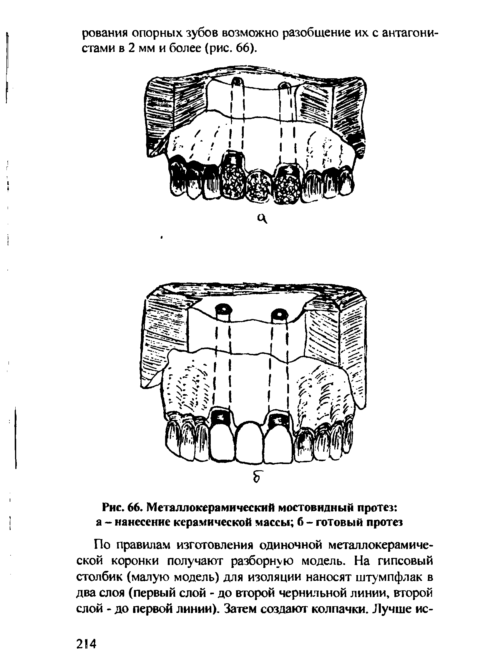 Рис. 66. Металлокерамический мостовидный протез а - нанесение керамической массы б - готовый протез...
