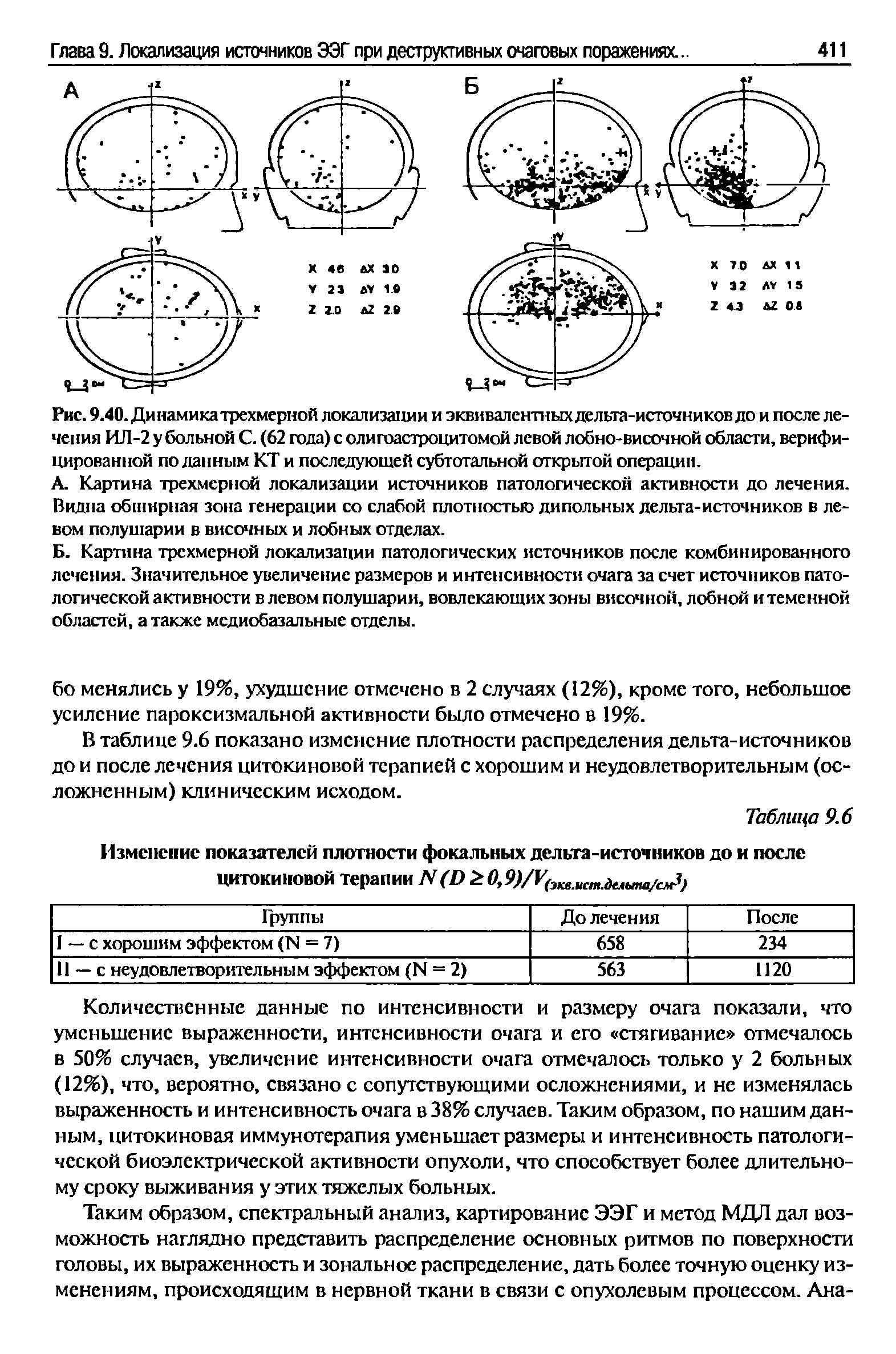 Рис. 9.40. Динамика трехмерной локализации и эквивалентных дельта-источников до и после лечения ИЛ-2 у больной С. (62 года) с олигоастроцитомой левой лобно-височной области, верифицированной поданным КТ и последующей субтотальной открытой операции.