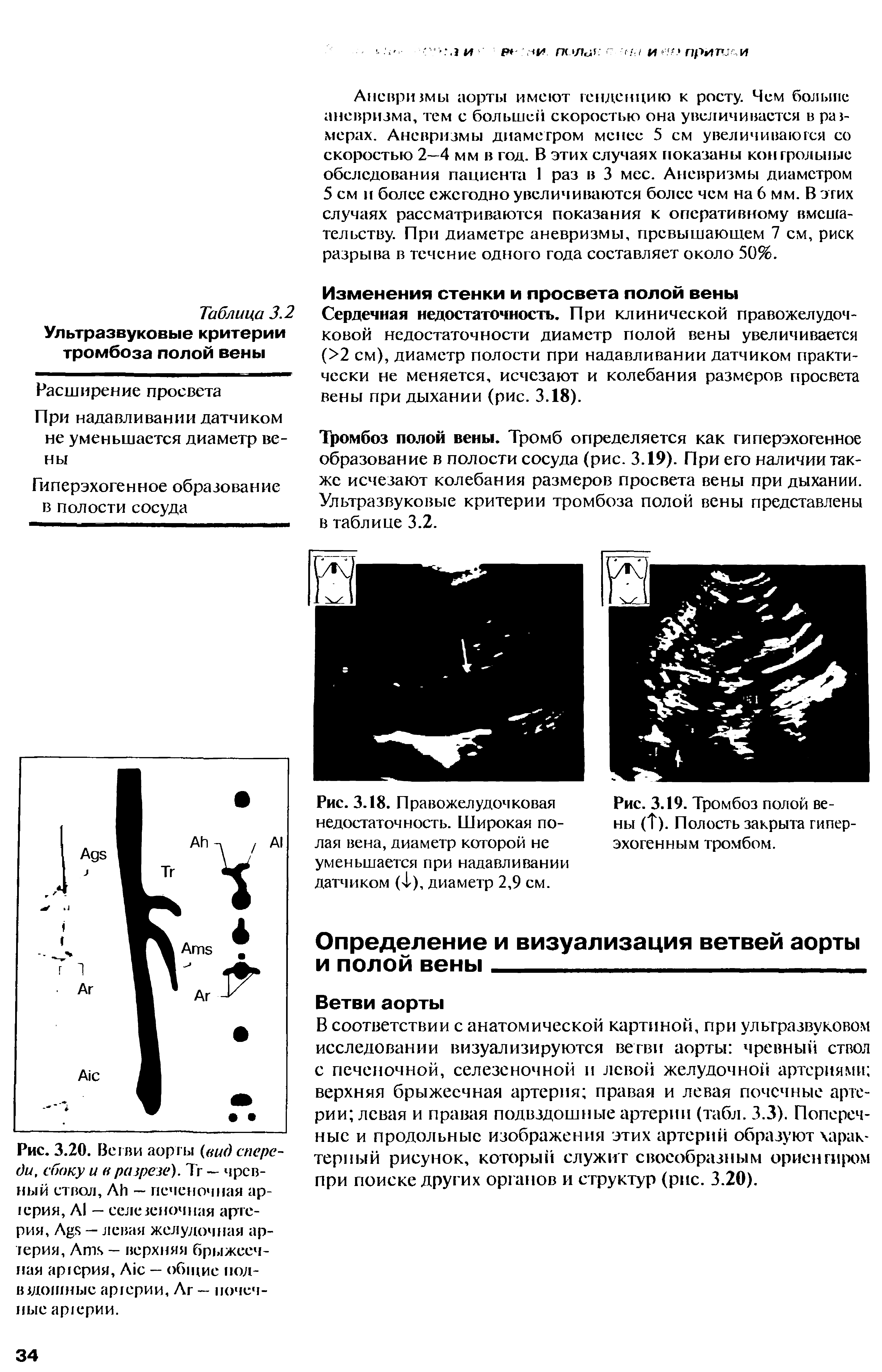 Рис. 3.20. Вс I ви аорты (вид спереди, сбоку и разрезе). Тг — чревный ствол, Ай — печеночная ар-<ерия, А1 — селе точная артерия, Айч — левая желудочная артерия, Атч — верхняя брыжеечная артерия, А1с — общие пол-в шинные артерии, Ат — почечные артерии.