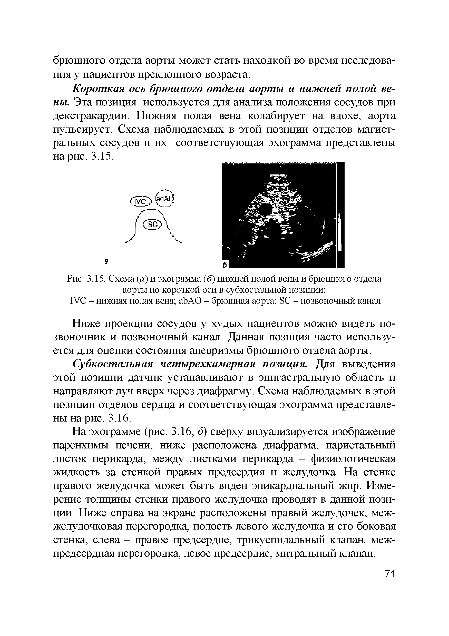 Рис. 3.15. Схема (а) и эхограмма (б) нижней полой вены и брюшного отдела аорты по короткой оси в субкостальной позиции ...