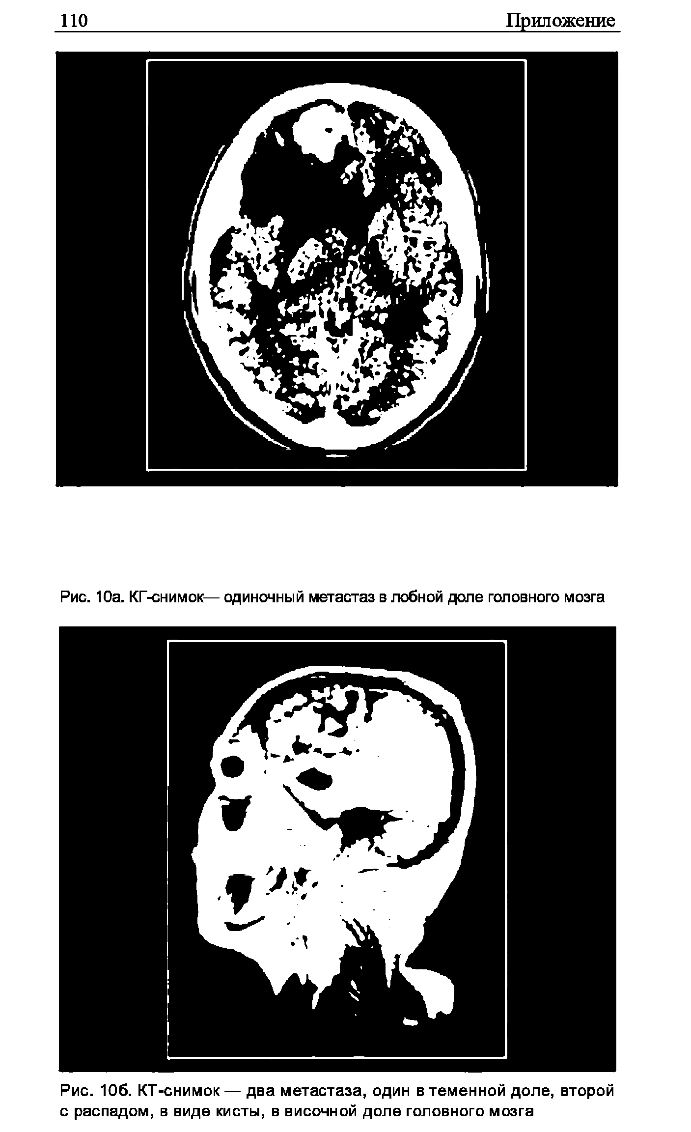 Рис. 106. КТ-снимок — два метастаза, один в теменной доле, второй с распадом, в виде кисты, в височной доле головного мозга...