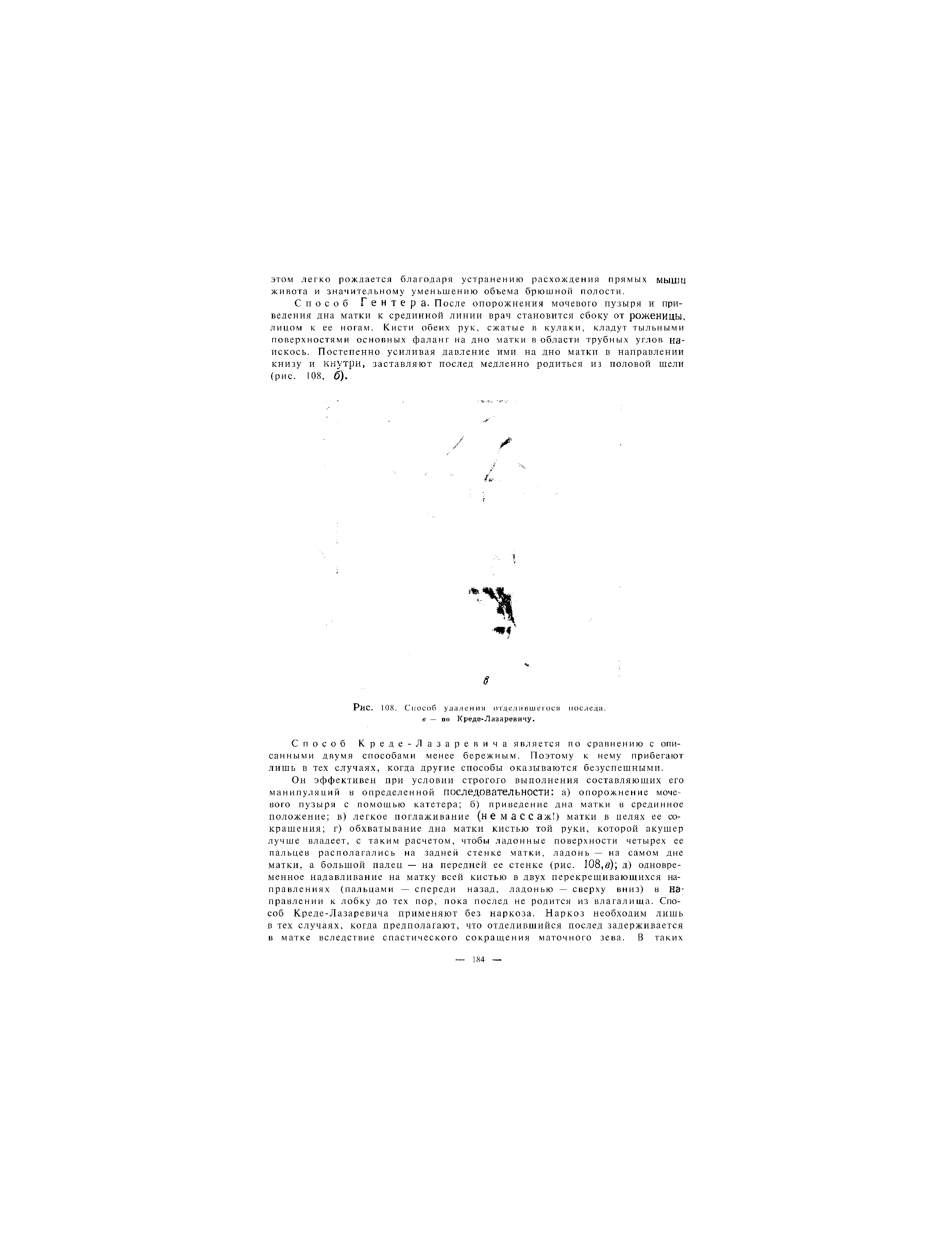 Рис. 108. Способ удаления отделившегося последа. в — по Креде-Лазаревичу.