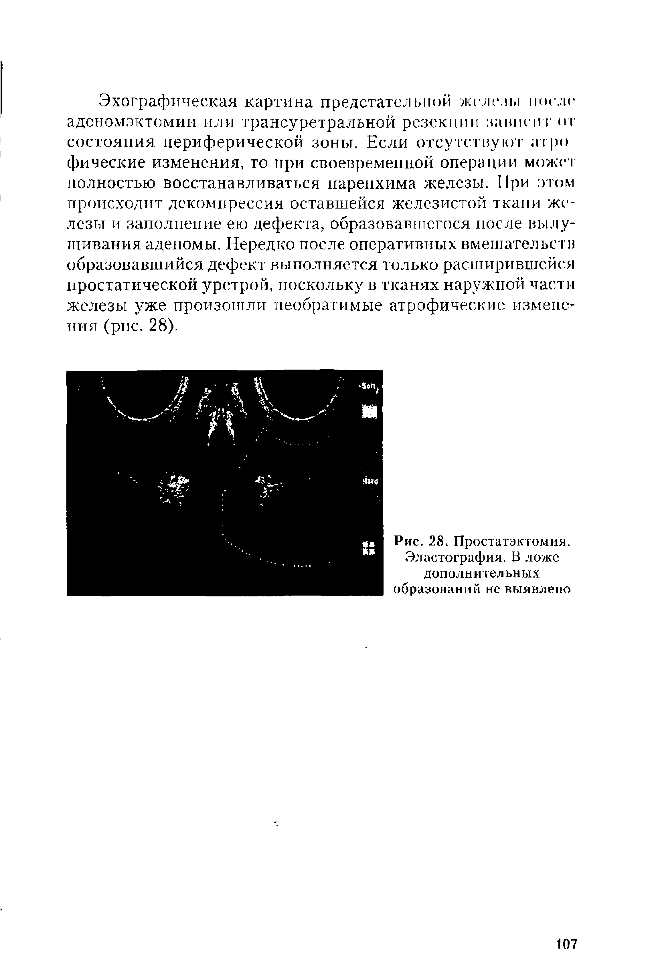 Рис. 28. Простатэктомия. Эластография. В ложе дополнительных образований нс выявлено...