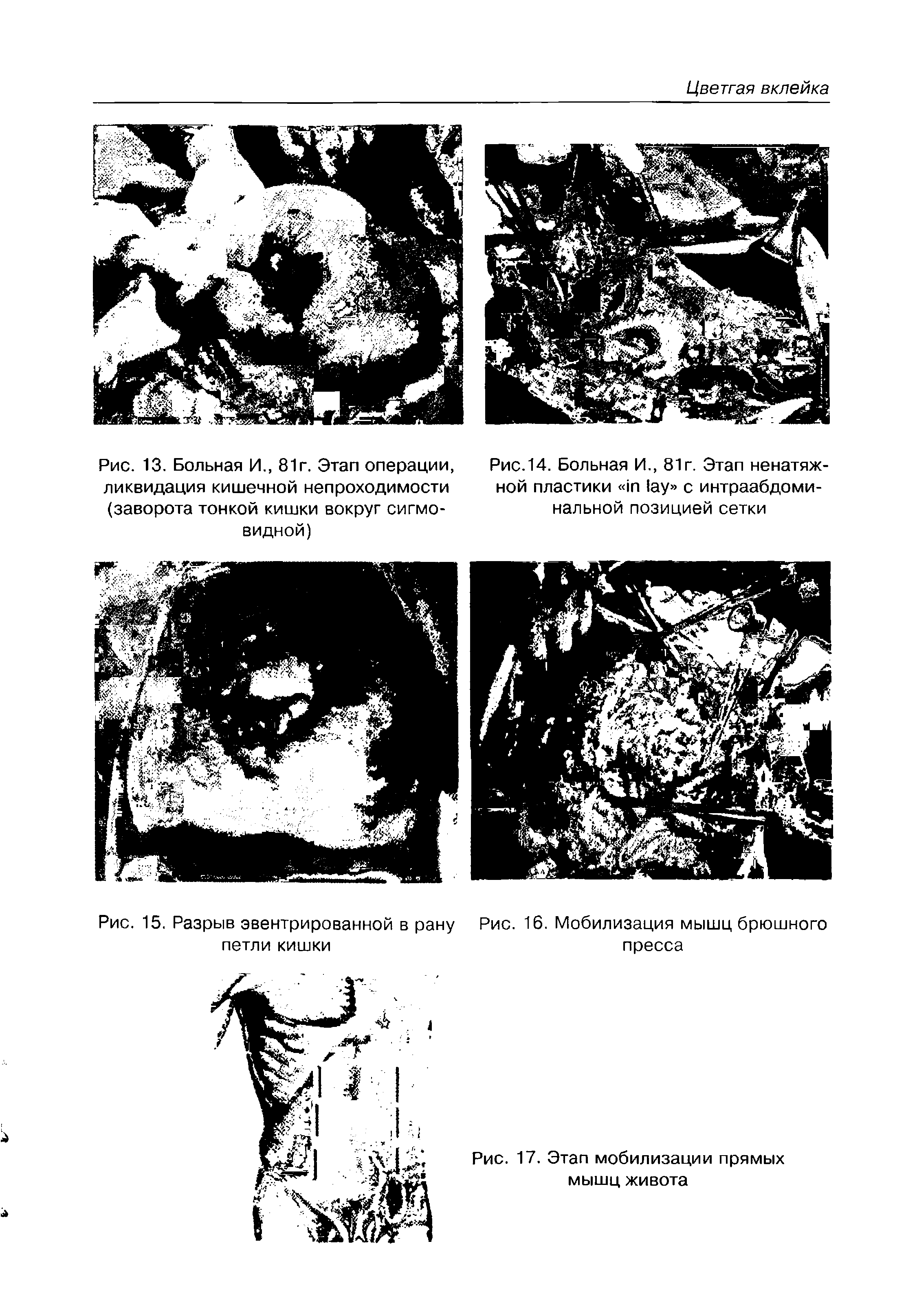 Рис. 13. Больная И., 81г. Этап операции, ликвидация кишечной непроходимости (заворота тонкой кишки вокруг сигмовидной)...