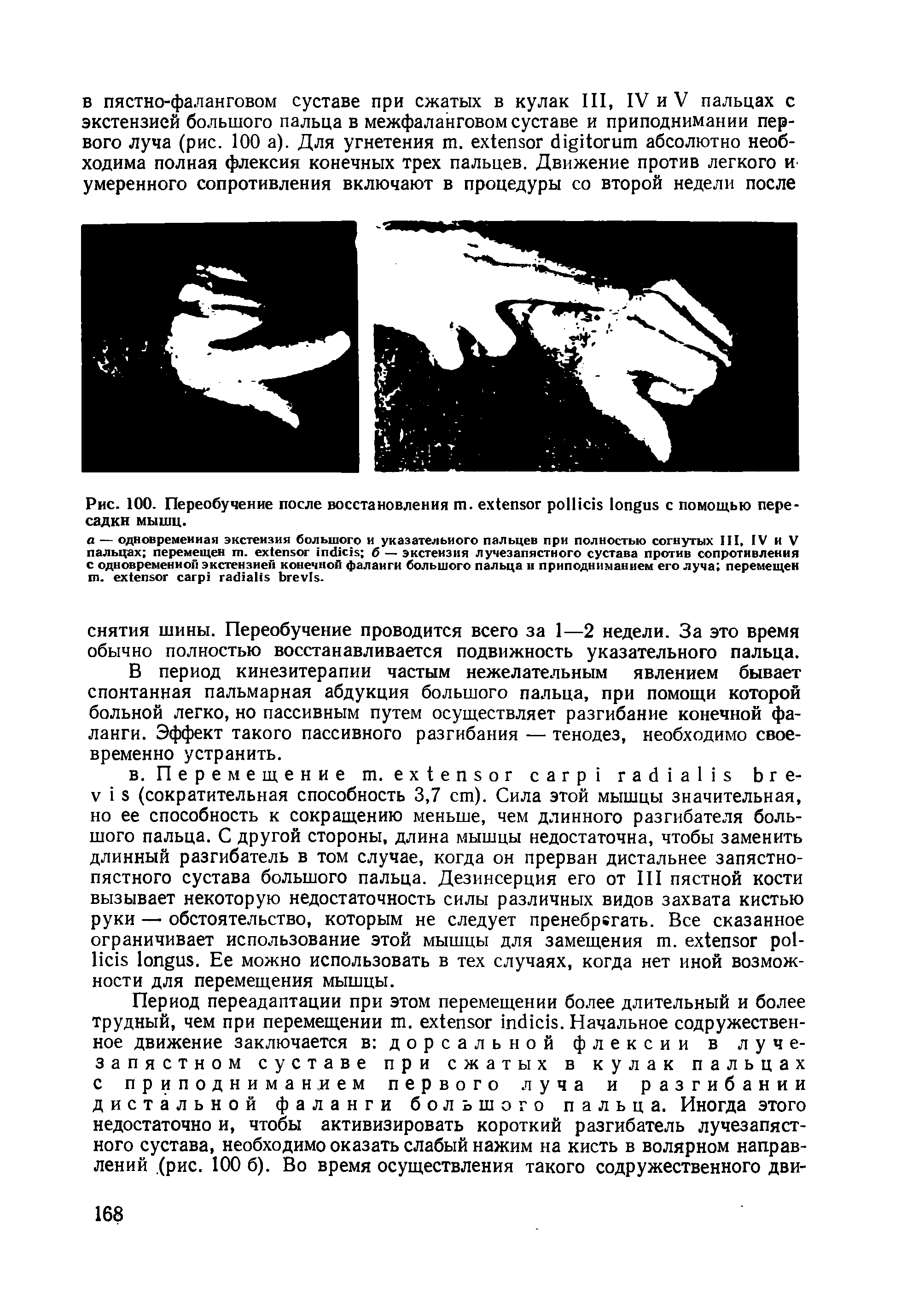 Рис. 100. Переобучение после восстановления . с помощью пересадки мышц.