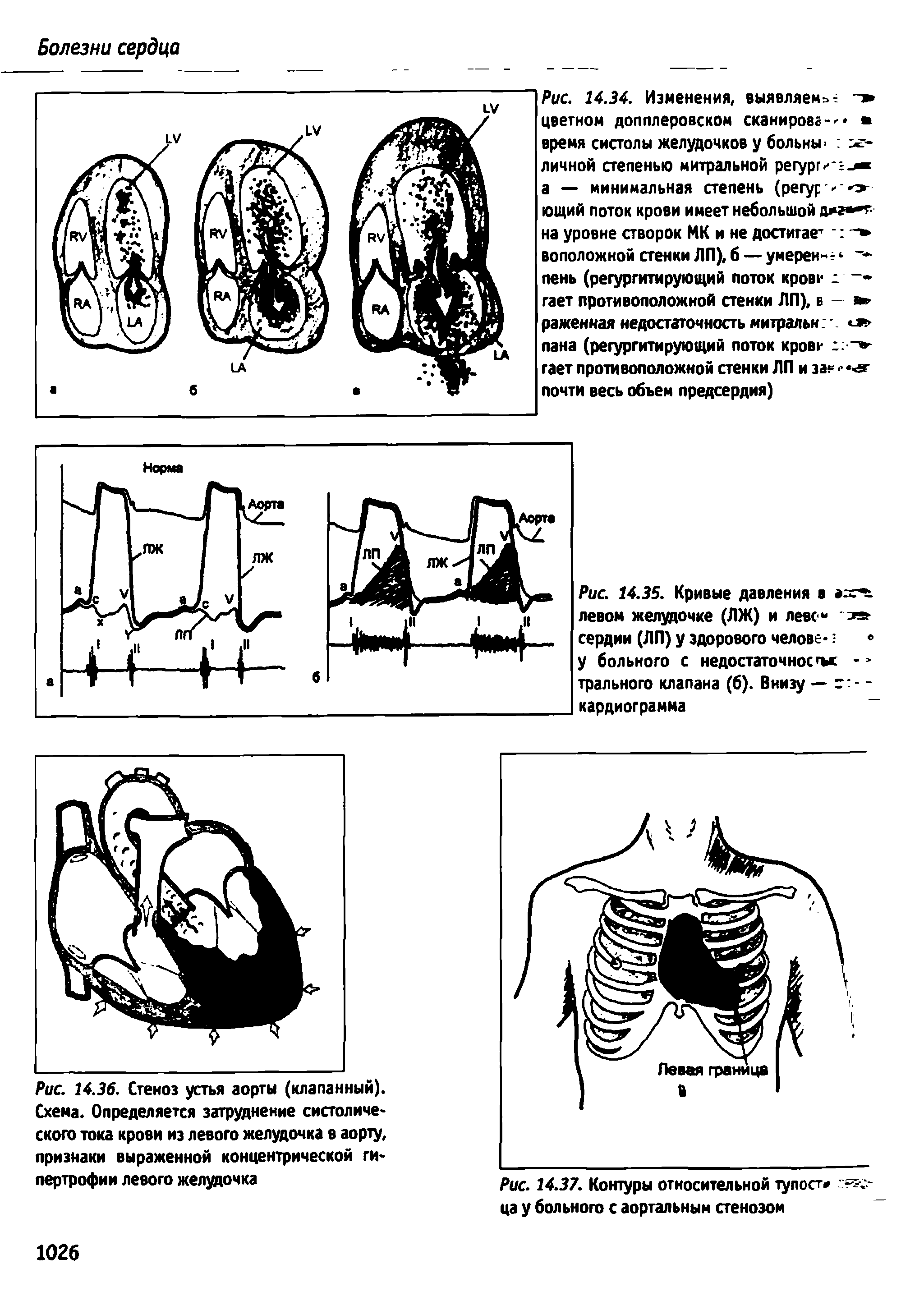 Рис. 14.36. Стеноз устья аорты (клапанный). Схема. Определяется затруднение систолического тока крови из левого желудочка в аорту, признаки выраженной концентрической гипертрофии левого желудочка...