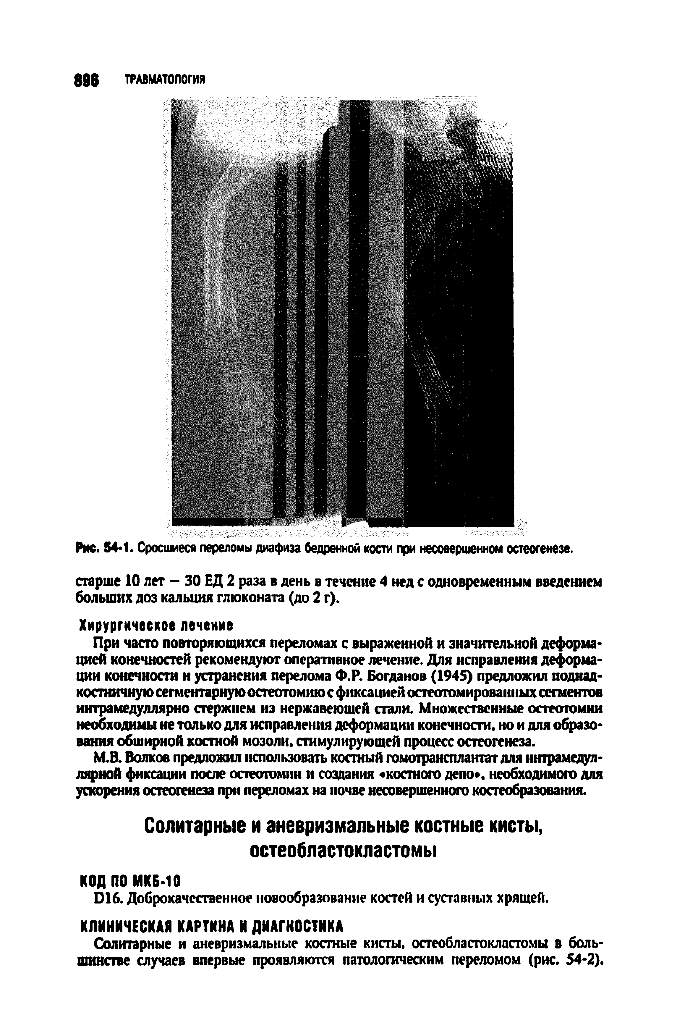 Рис. 54 1. Сросшиеся переломы диафиза бедренной кости при несовершенном остеогенезе, старше 10 лет - 30 ЕД 2 раза в день в течение 4 нед с одновременным введением больших доз кальция глюконата (до 2 г).