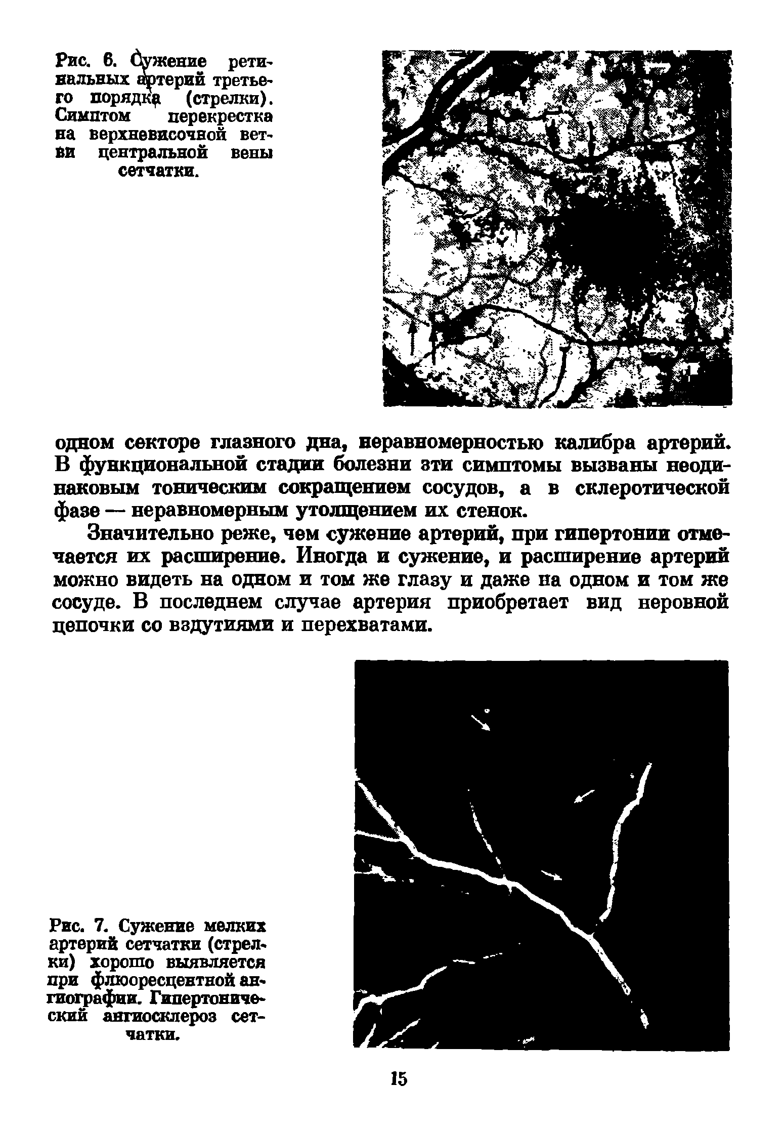 Рис. 7. Сужение мелких артерий сетчатки (стрелки) хорошо выявляется при флюоресцентной ангиографии. Гипертонический ангиосклероз сетчатки.