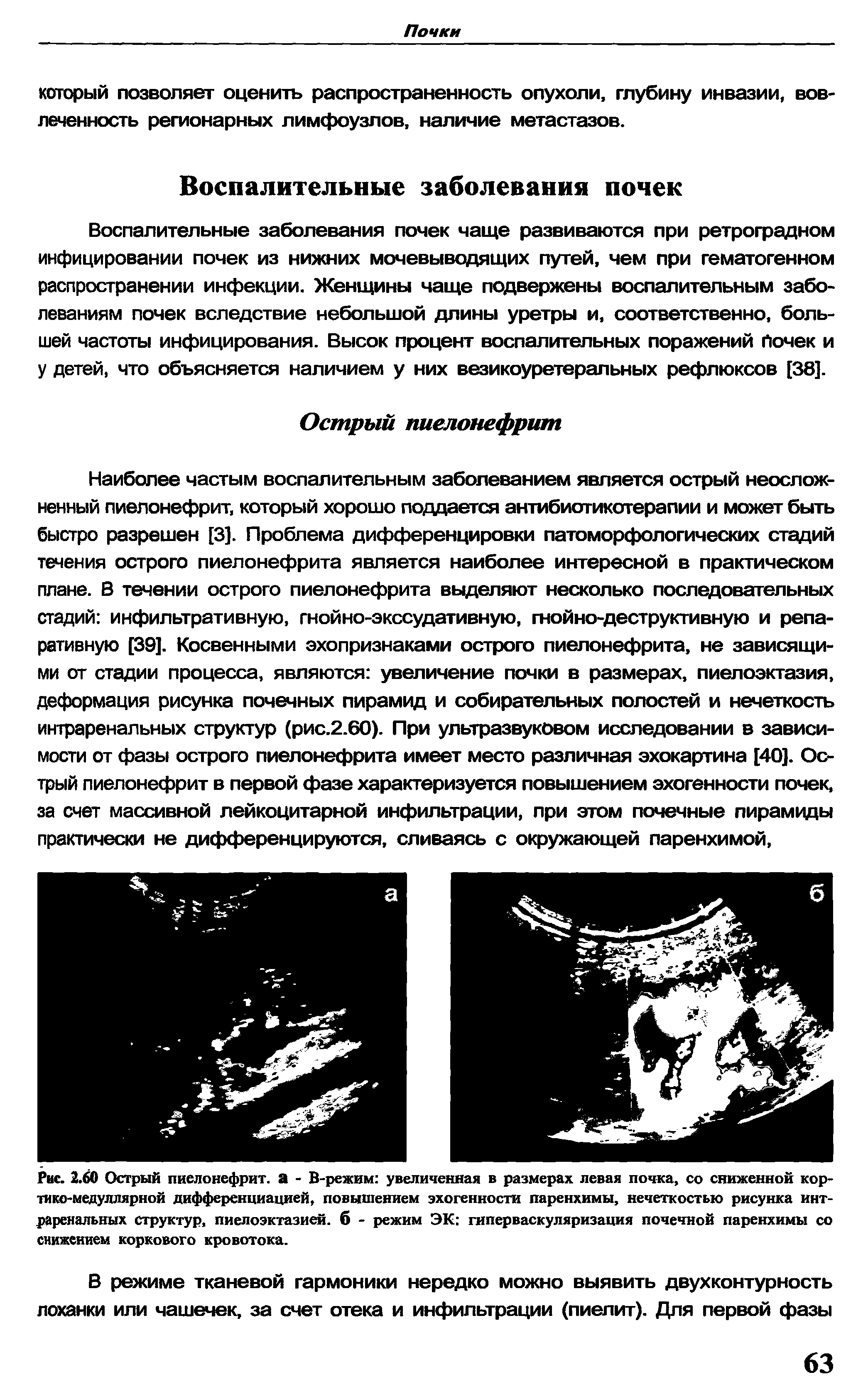 Рис. 2.60 Острый пиелонефрит, а - В-режим увеличенная в размерах левая почка, со сниженной кортико-медуллярной дифференциацией, повышением эхогенности паренхимы, нечеткостью рисунка интраренальных структур, пиелоэктазией, б - режим ЭК гиперваскуляризация почечной паренхимы со...