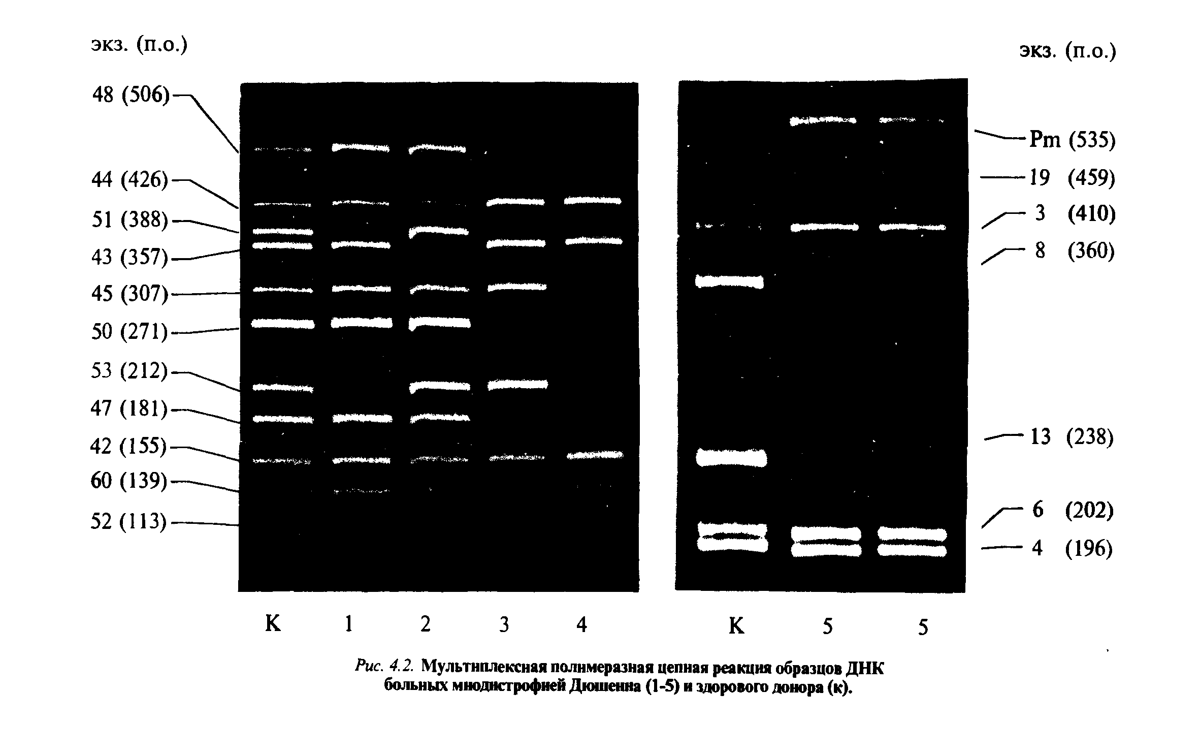 Рис. 4.2. Мультиплексная полимеразная цепная реакция образцов ДНК больных мнодистрофией Дюшенна (1-5) и здорового донора (к).