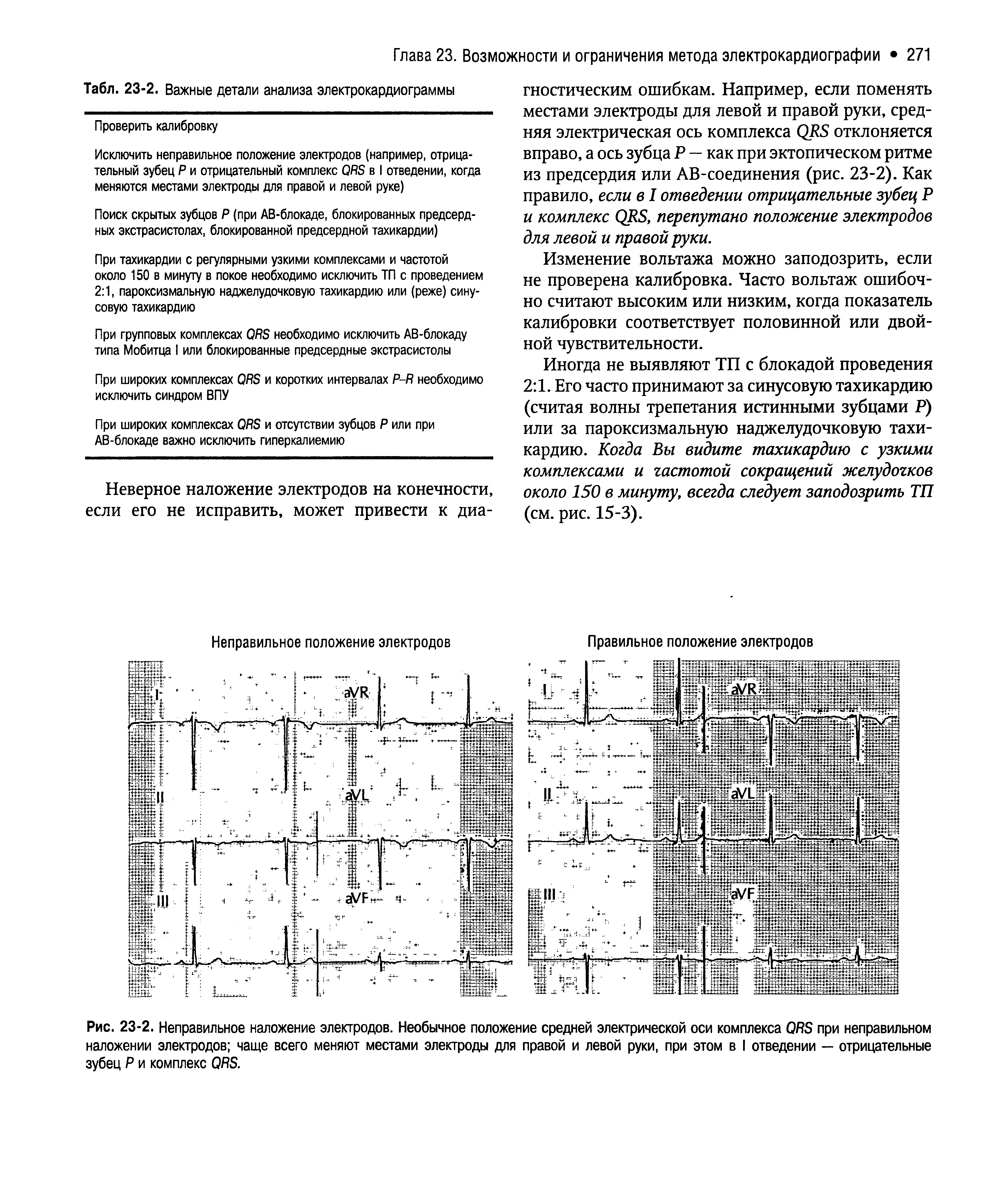 Рис. 23-2. Неправильное наложение электродов. Необычное положение средней электрической оси комплекса ОЯБ при неправильном наложении электродов чаще всего меняют местами электроды для правой и левой руки, при этом в I отведении — отрицательные зубец Р и комплекс ОЯБ.