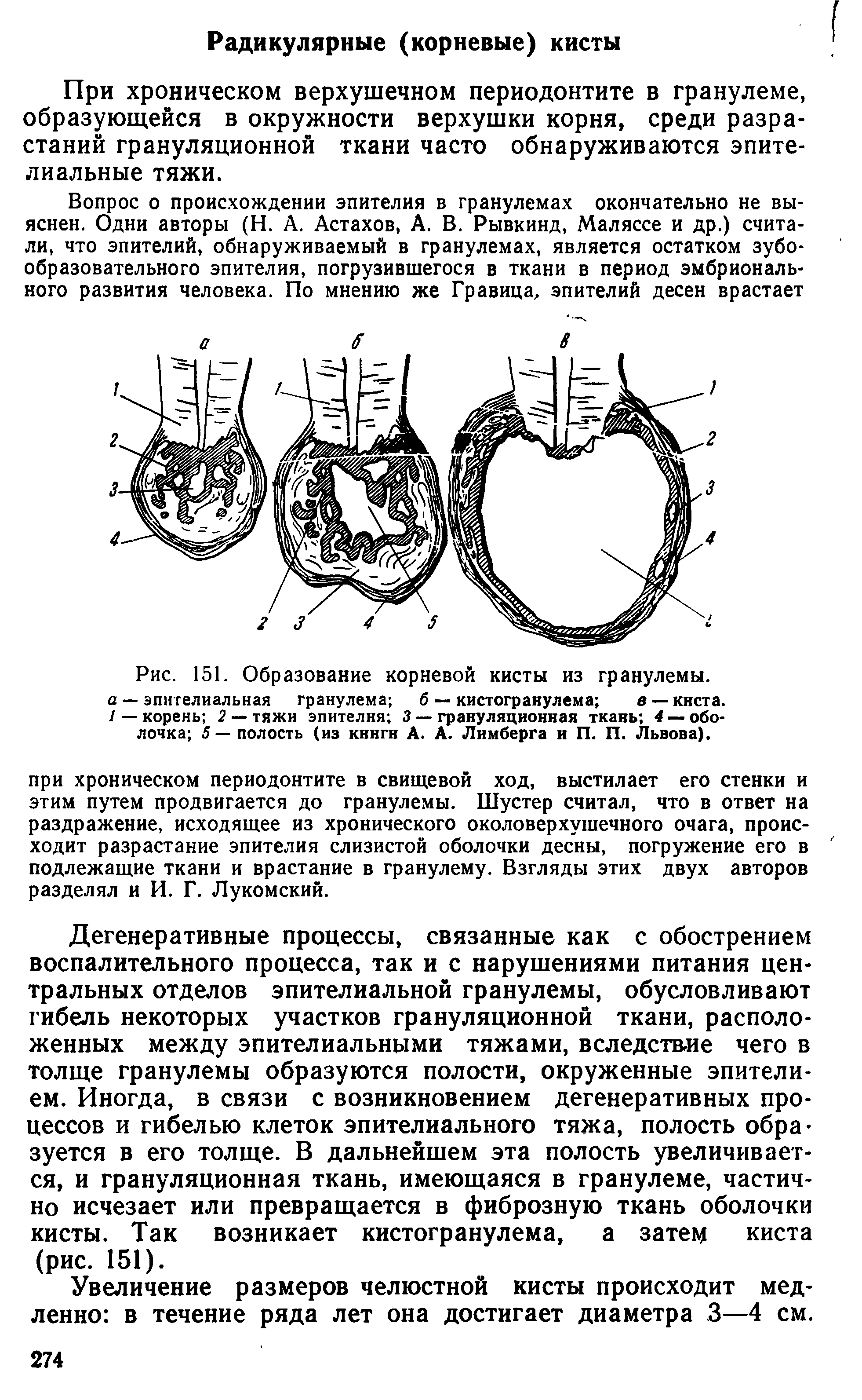 Рис. 151. Образование корневой кисты из гранулемы. а — эпителиальная гранулема б — кистогранулема в — кнста. 1 — корень 2 — тяжи эпителия 3 — грануляционная ткань 4 — оболочка 5 — полость (из книги А. А. Лимберга и П. П. Львова).