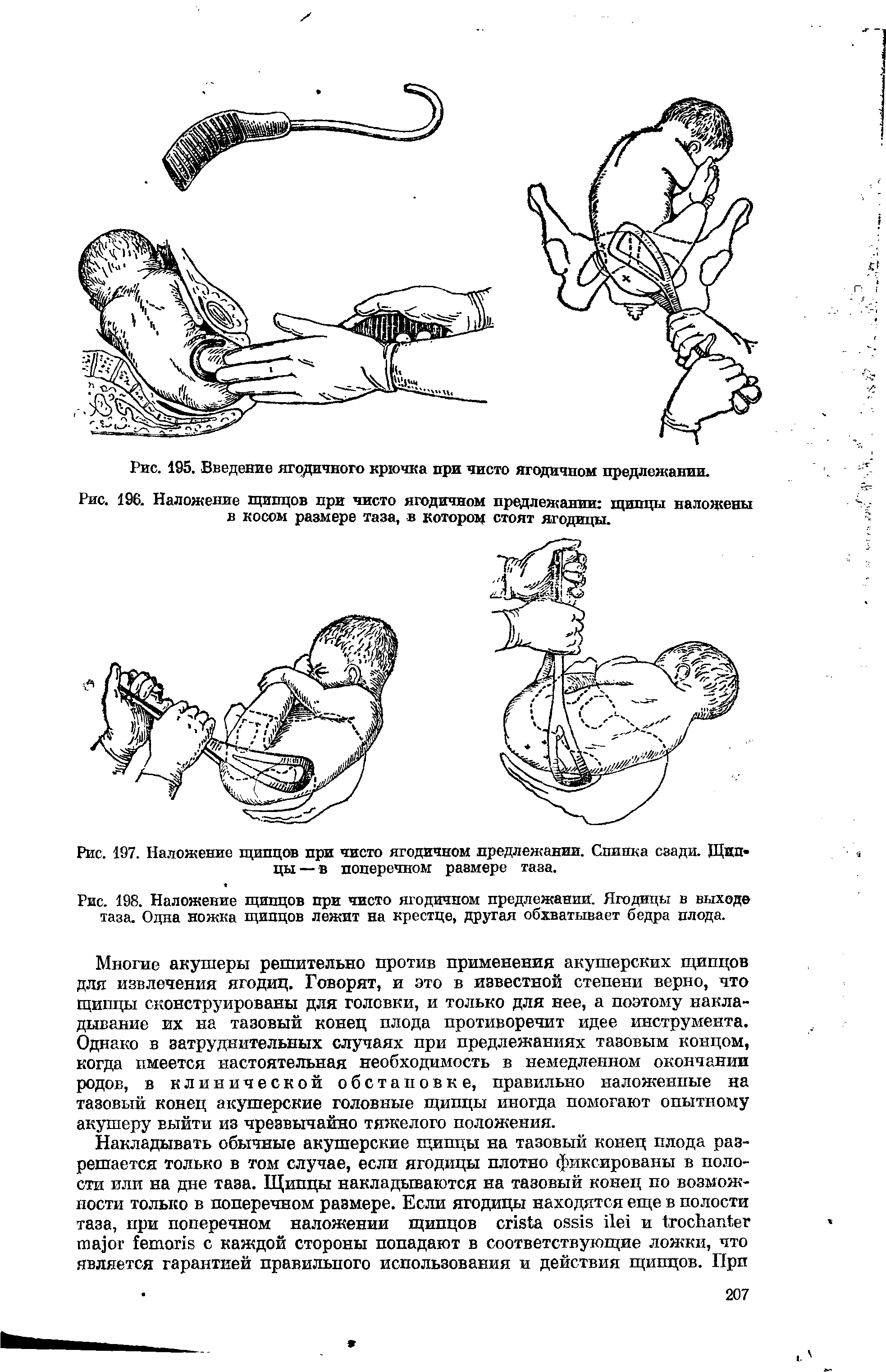 Рис. 198. Наложение щипцов при чисто ягодичном предлежании. Ягодицы в выходе таза. Одна ножка щипцов лежит на крестце, другая обхватывает бедра плода.