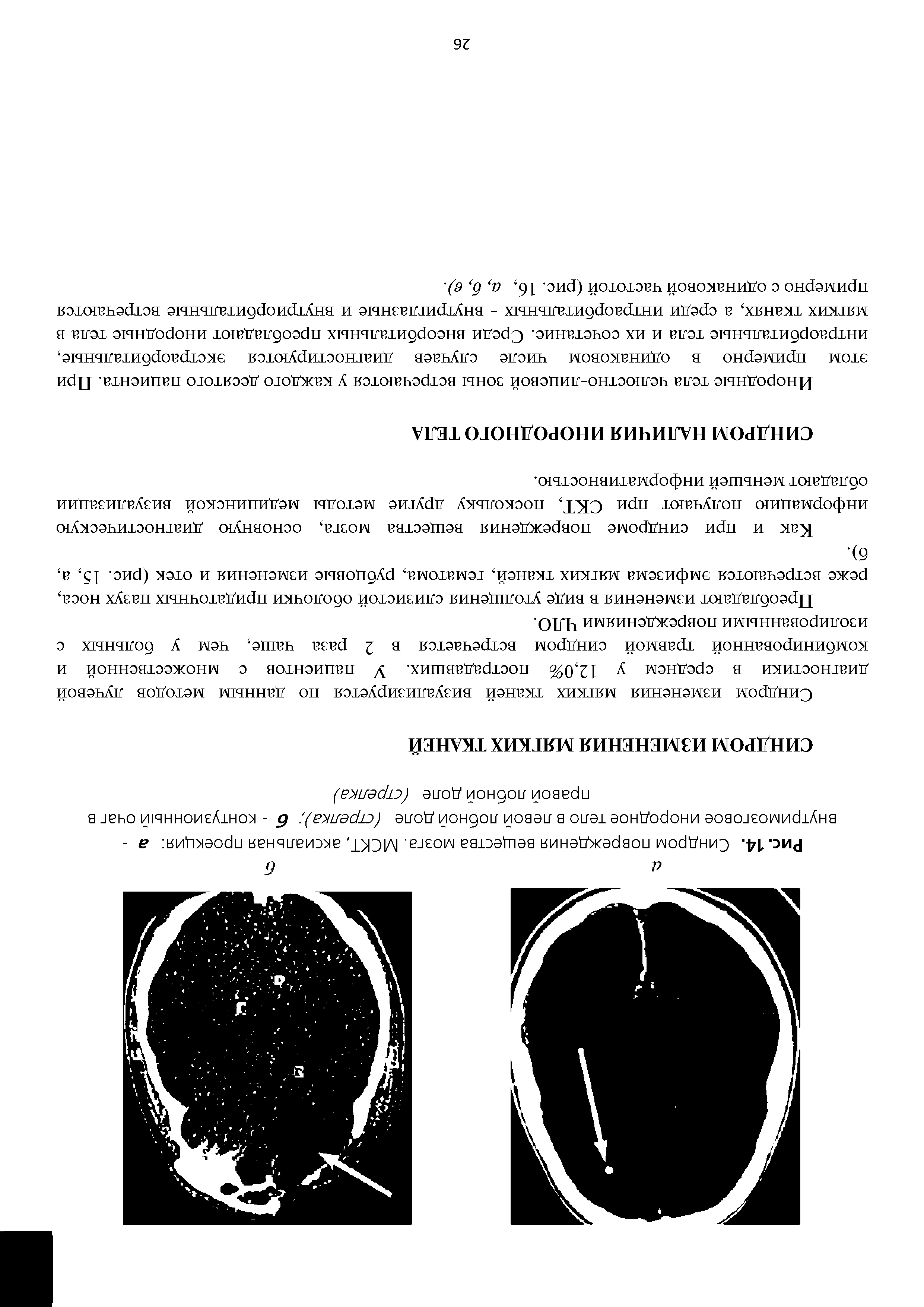 Рис. 14. Синдром повреждения вещества мозга. МСКТ, аксиальная проекция а -внутримозговое инородное тело в левой лобной доле (стрелка) б - контузионный очаг в правой лобной доле (стрелка)...