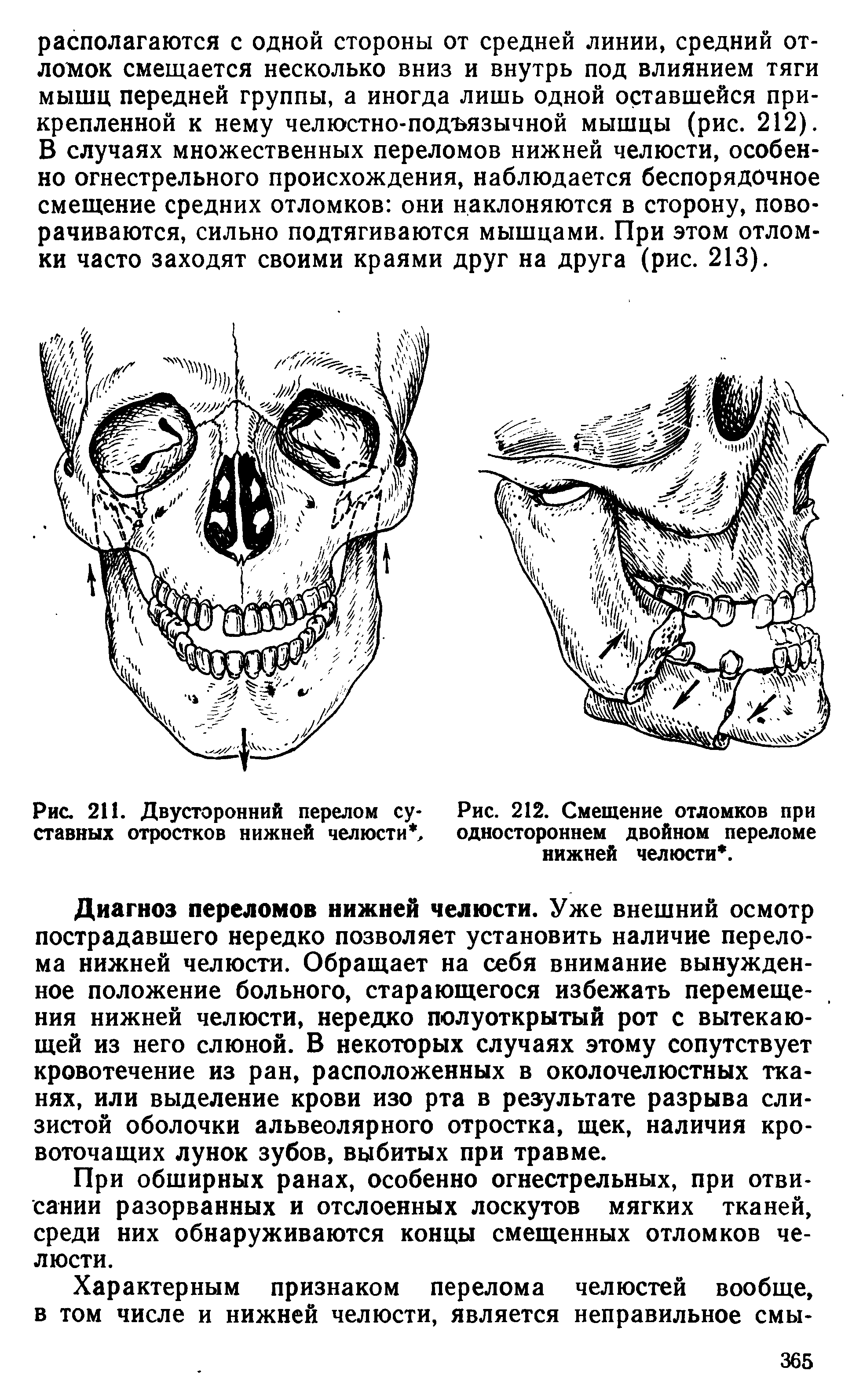 Рис. 211. Двусторонний перелом суставных отростков нижней челюсти, ...