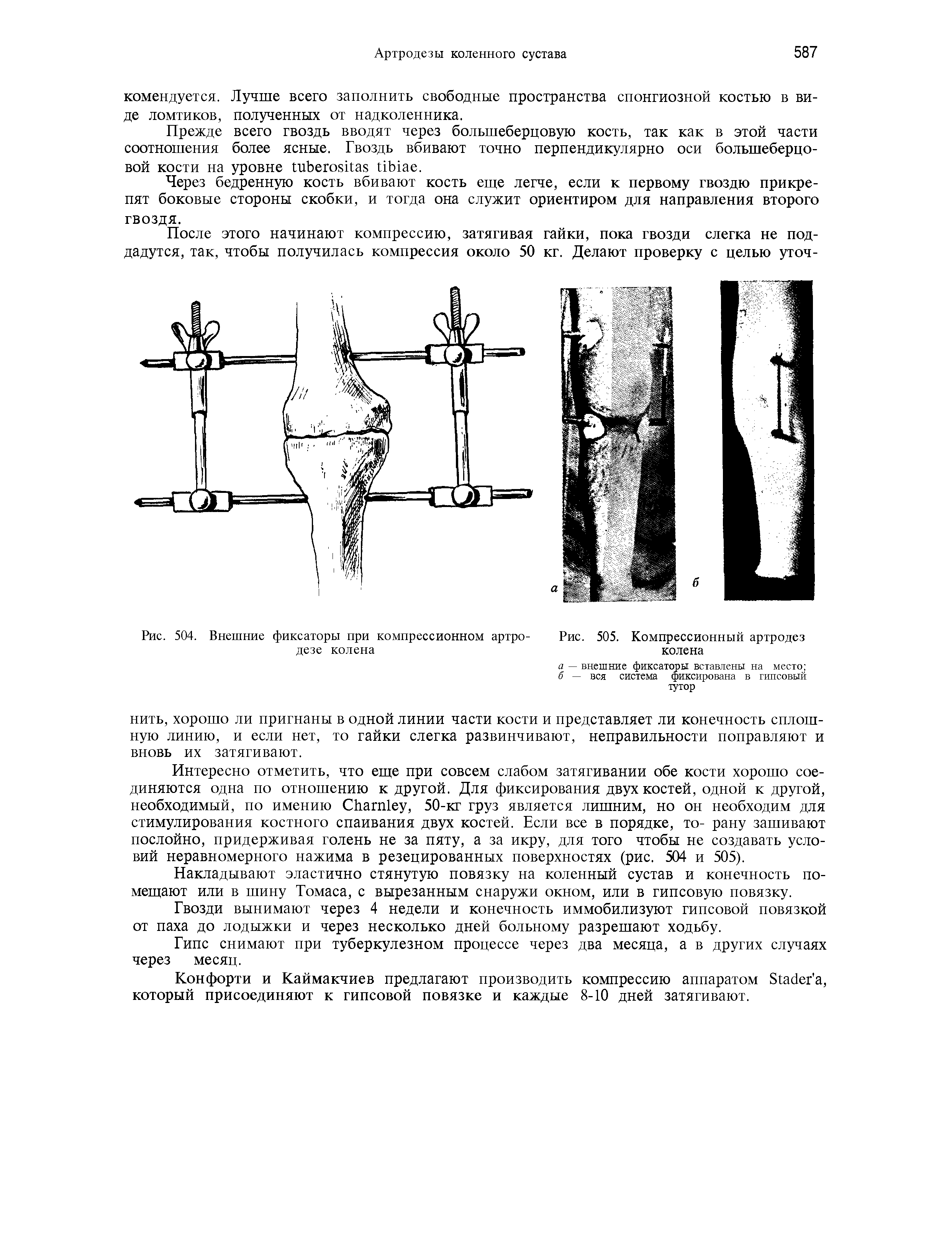 Рис. 504. Внешние фиксаторы при компрессионном артро- Рис. 505. Компрессионный артродез...