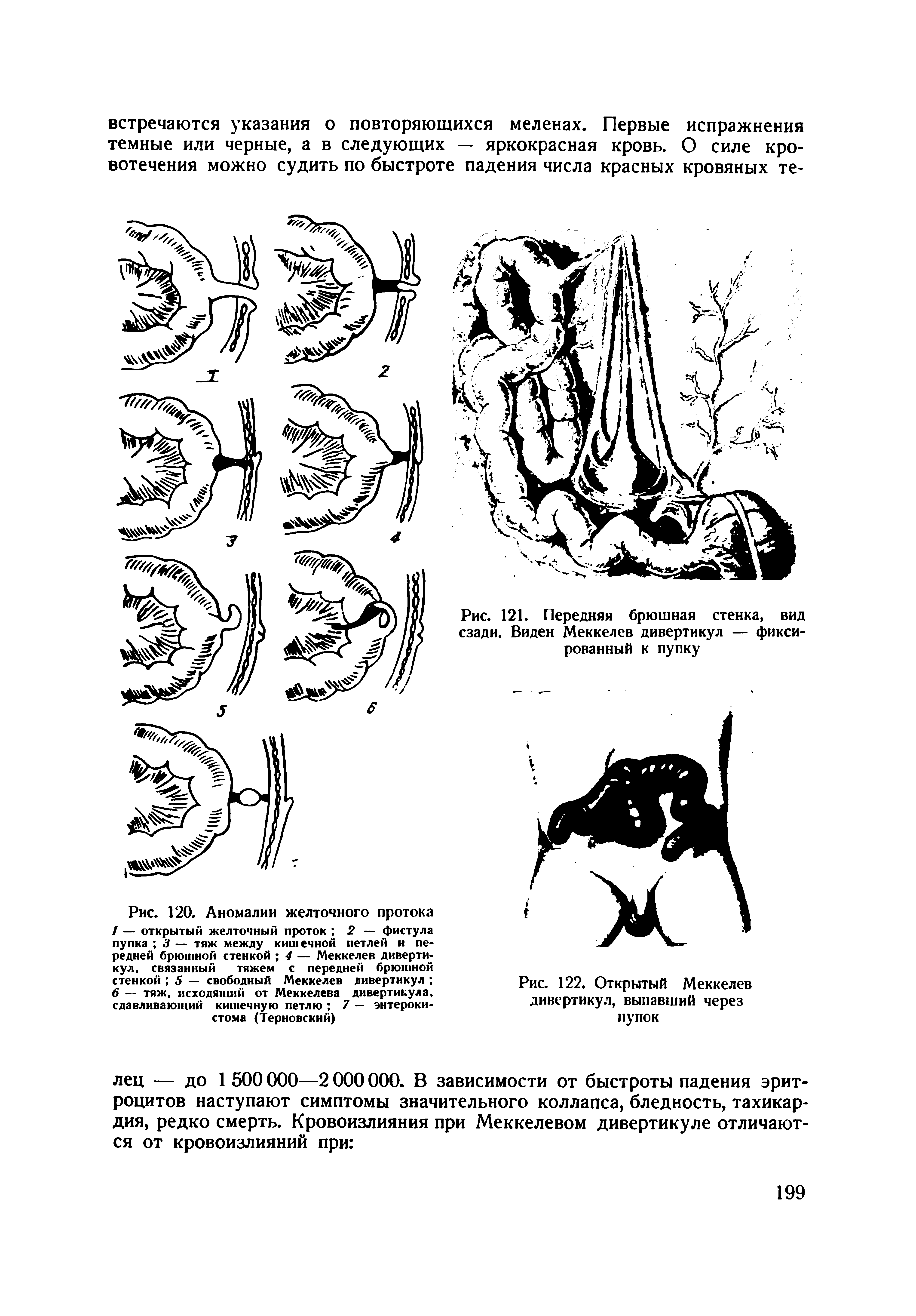 Рис. 120. Аномалии желточного протока / — открытый желточный проток 2 — фистула пупка 3 — тяж между кишечной петлей и передней брюшной стенкой 4 — Меккелев дивертикул, связанный тяжем с передней брюшной стенкой 5 — свободный Меккелев дивертикул 6 — тяж, исходящий от Меккелева дивертикула, сдавливающий кишечную петлю 7 — энтерокистома (Терновский)...